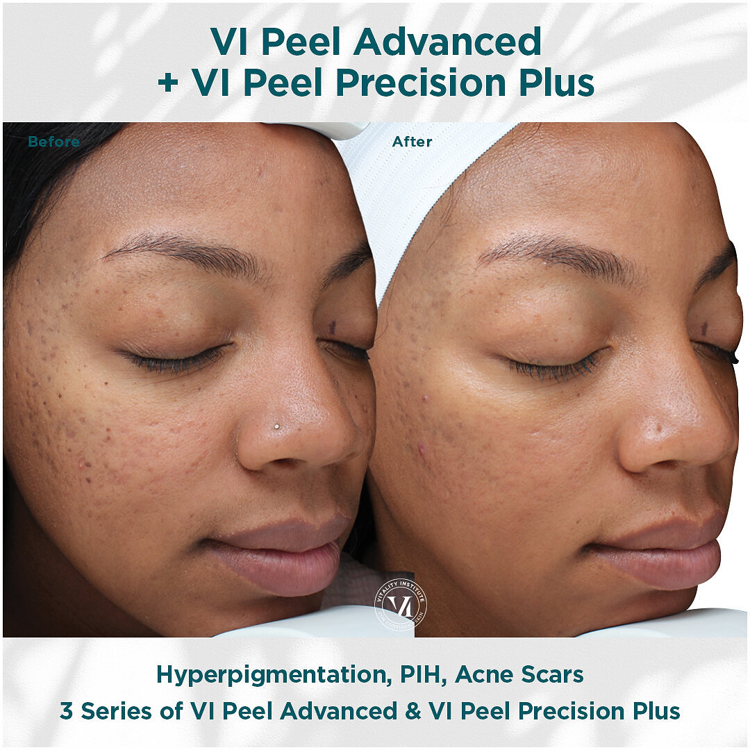 Want smoother, clearer skin? Vi Peel might be your answer! This treatment reduces signs of aging and improves skin texture. Get incredible results with just one session! Link in Bio #ViPeel #SkincareRoutine #BeautyByStefany
