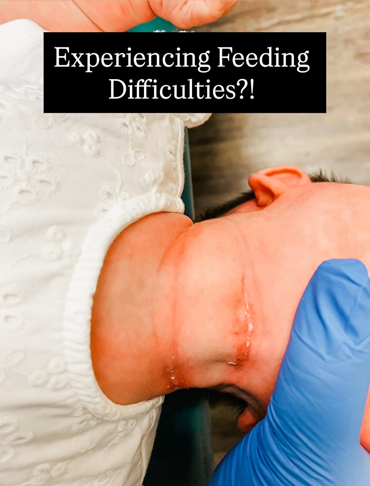 Is your baby having difficulties feeding on either the bottle or at the breast? Have you thought to look at/under their neck?!
Neck tension can have an ENORMOUS impact on feeding!
Tension lines under the neck (this photo is fairly on the extreme end of neck tension; tension lines can be much less deep, wide, and yeast-like and still have a significant impact), hunched shoulders, baby tucking their neck in forward flexion, and the inability to see your baby’s full neck at all/most times, should be addressed for many reasons.
It can inhibit the proper undulation of the tongue, cause tension in the jaw, hyoid and other facial bones like the sphenoid, or cause significant muscle tension that disallows for effective feeding. Tension can even impact proper GI function and proper breathing!
This can likely be initiated by womb position, cord presentation, birth trauma, and can be a sign of oral restrictions.
Reach out to us for a feeding evaluation, and we should be able to refer you to the proper providers for Infant Bodywork 💙
#tonguetie #tonguetied #frenectomy #infant #newmom #newborn #newbaby #breastfeedingmom #breastfeedingmama #breastfeedingsupport #birthtrauma #breastfedbabies #breastfedbabe #bottlefeeding #momsofinstagram #momssupportingmoms #motherhoodunplugged #motherhoodthroughinstagram #motherhoodrising #breastfeedingtips #newbornbaby #newborn
#momsofinstagram #newmama #momsofig #infants #feedingbaby #cranialsacraltherapy #cranialsacral