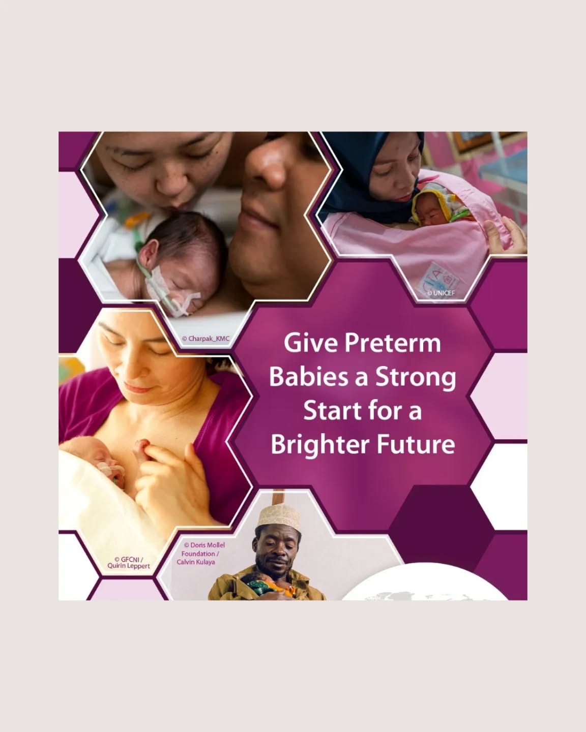 Vandaag is het officieel wereld prematurendag 👶🏼
En we willen daar toch wel even bij stilstaan, want ongeveer 8% van de baby's in België wordt te vroeg geboren 😟
Met alle gevolgen van dien. Want hoe vroeger de baby geboren wordt, hoe lager de overlevingskans en hoe hoger de kans op blijvende gevolgen 😥
Die gevolgen hebben een impact op zowel de korte als de lange termijn. Op korte termijn kunnen ze problemen hebben met de luchtwegen 🫁, maag, darmen, hersenen 🧠, voeding, gehoor, het zicht 👀,...
Op lange termijn zien we dan weer meer leer-, gedrags-, ontwikkelingsproblemen 📖,...
En ook voor de ouders kan het een groot emotioneel, psychologisch en financieel impact hebben.
We moeten er dus alles aan doen om dit te vermijden. En dat begint bij jullie goed informeren en jullie goed omringen met een mooi netwerk 💞
Ook wij behoren graag tot dat netwerk!
#wereldprematurendag
#care4neo
#prematuriteit
#tevroeggeboren
#kennisismacht
#kennisiskracht
#stevignetwerk