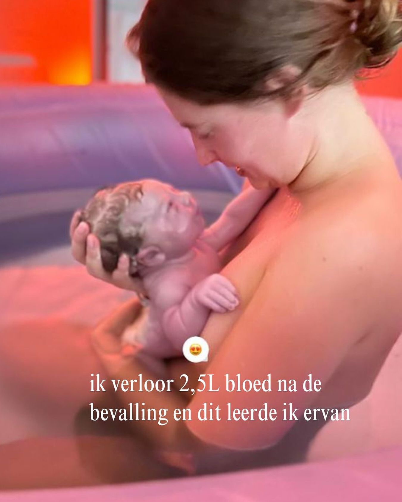 Ik weet het nog als de dag van gisteren dat ik naar het ziekenhuis werd gereden met de ambulance.
De ‘’klikjes’’ als het ambulance bedje de wagen in rijdt en er weer uit rijdt, de sirenes en de ambulance vrouw haar blik.
Ik ben nog nooit zo bang geweest om het leven te verliezen en ik heb nog nooit zo hard gestreden om wakker te blijven.
Bizar wat voor impact het vele bloedverlies heeft op je lijf.
Ik kon amper op mijn benen staan of zelf naar de wc terwijl mijn bevalling verder echt easy was.
Ik zei daarna nog ‘’dit kan ik iedere week wel doen’’. Alleen het bloedverlies (fluxus) kwam pas later..
Als vrouw heb je ongeveer 4-5L bloed en mijn HB, was zon 6 weken na de bevalling alweer op 7.7. Na de bevalling was het onder de 4. Je lijf kan Hb heel snel herstellen - mits de juiste voedingstoffen er zijn - maar het komt wél ergens vandaan.
Net zoals mijn specialisatie in huid, hormoon en darmklachten (die ik zelf ook allemaal heb ervaren) ben ik hier ook helemaal ingedoken. Met een mega impact bij mijzelf en bij klanten, zo gaaf!
Bloed is letterlijk leven. Het vervoert zuurstof, energie en afweer (immuunsysteem).
👉 Hb (hemoglobine): bindt zuurstof aan je rode bloedcellen. Is je Hb te laag dan krijgen je hersenen en spieren simpelweg minder zuurstof. Iedereen met een laag hb die herkent dit. Je voelt je wazig, slap en bent buiten adem bij de kleinste inspanning.
👉 Ferritine: Is je ijzervoorraad. Te laag? je lichaam kan geen rode bloedcellen aanmaken. Je raakt sneller uitgeput, herstel duurt langer, haaruitval neemt (enorm) toe.
👉 IJzer. Zorgt voor energieproductie in je cellen (ATP). Je lijf bestaat uit 36.000.000.000.000 cellen. Te weinig ijzer = te weinig energie in je hele lijf!! Schildkliercellen, levercellen, huidcellen, darmcellen, breincellen…
Vitamine C, B11 en B12 hebben een mega belangrijke rol in het op peil houden van je ijzer waardes.
Ben jij bekend met een te laag Hb of ijzer?