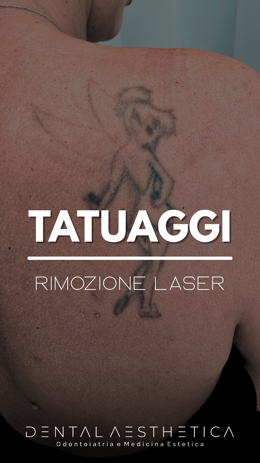 Quel tatuaggio NON è per sempre. (Per fortuna) 🔥
Ti sei mai guardato allo specchio pensando:
“Questo tatuaggio non mi rappresenta più…”?
Nel video ti spieghiamo come funziona davvero la rimozione laser dei tatuaggi in clinica medica:
- il laser frammenta i pigmenti sotto la pelle
- il corpo li elimina gradualmente nelle settimane successive
- il risultato non arriva in una sola seduta (e ti spiego perché)
Niente promesse miracolose, solo:
- protocollo medico
- valutazione personalizzata
- attenzione a colore, posizione e profondità del tatuaggio
🧾 Domande che riceviamo più spesso:
• Fa male? 👉 fastidio gestibile, ma è soggettivo. Lavoriamo sempre con creme anestetiche.
• Quante sedute servono? 👉 dipende da colore, estensione e da come è stato fatto il tatuaggio.
• Rimarranno segni? 👉 l’obiettivo è ridurre al minimo i segni visibili, ma ogni pelle reagisce in modo diverso.
💡 Se stai pensando di coprirlo con un tatuaggio più grande, prima guarda questo video.
👉 Salva il reel per quando deciderai di fare il passo
👉 Invialo a quella persona che dice sempre: “Prima o poi questo tatuaggio lo tolgo…”
Se vuoi capire se il tuo tatuaggio si può rimuovere in sicurezza, scrivimi in DM con scritto “TATUAGGIO” e una foto in buona luce.