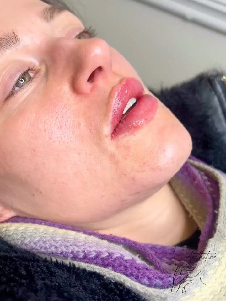 A small tweak, big difference.
This enhancement uses just 0.5ml for added definition and a naturally fuller look 💉
Discounts on lip enhancements as a part of our festive deals 🎄
CeTe Aesthetics
👩🏽⚕️ Registered Nurse
📧 chloe@ceteaesthetics.co.uk
📲 www.ceteaesthetics.co.uk
📍 278 Ashby High Street, Scunthorpe, DN162RX
-
#lipfillersscunthorpe #Lipfillersengland #Lipfillers #Lipfiller #Lipfillersuk #Lipfillervideo #Lipinjections #Lipenvy #Russainlips #Naturallipfiller
#Lipaugmentation #Lipgoals #lipenhancement
#safeaesthetics