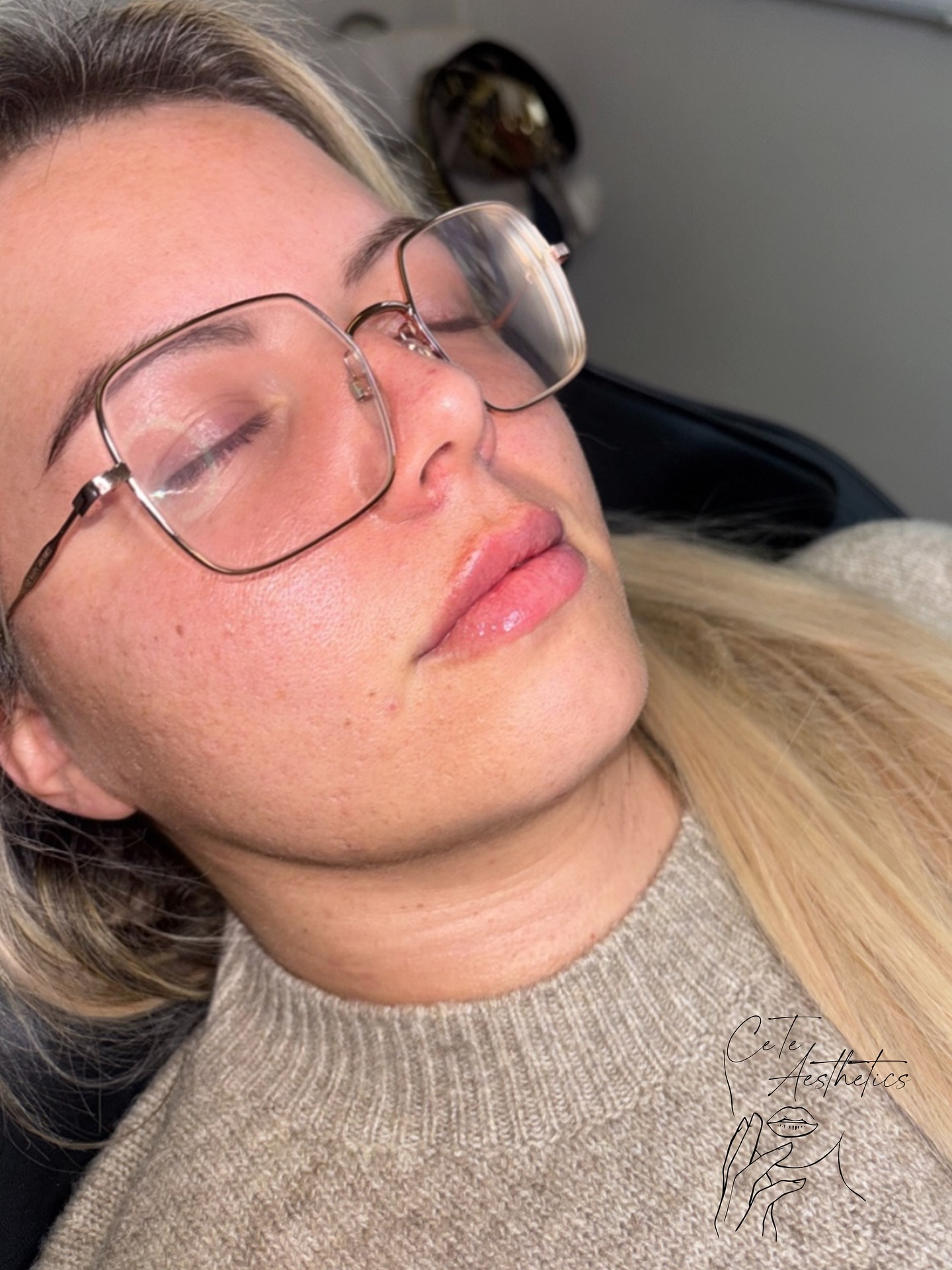 A tailored approach to lip enhancement designed to enhance shape, support structure, and preserve natural beauty.
Premium products. Expert techniques. Impeccable results. 💎
Celebrate the festive season with exclusive savings.
Reserve your appointment now and enjoy your treatment at any time — your festive discount remains guaranteed whether that’s in December or 2026 ✨
Book online via our website
www.ceteaesthetics.co.uk
-
#ScunthorpeAesthetics #NorthLincolnshire #CeteAesthetics #ScunthorpeClinic #LincolnshireBeauty #SkinClinicUK #FestiveOffers #ChristmasBeautyDeals #HolidayGlowUp #FestiveSavings #WinterSkinRefresh #BeautyOffersUK #AestheticsOffers #ClinicDeals #HolidayPamper #lipenhancement