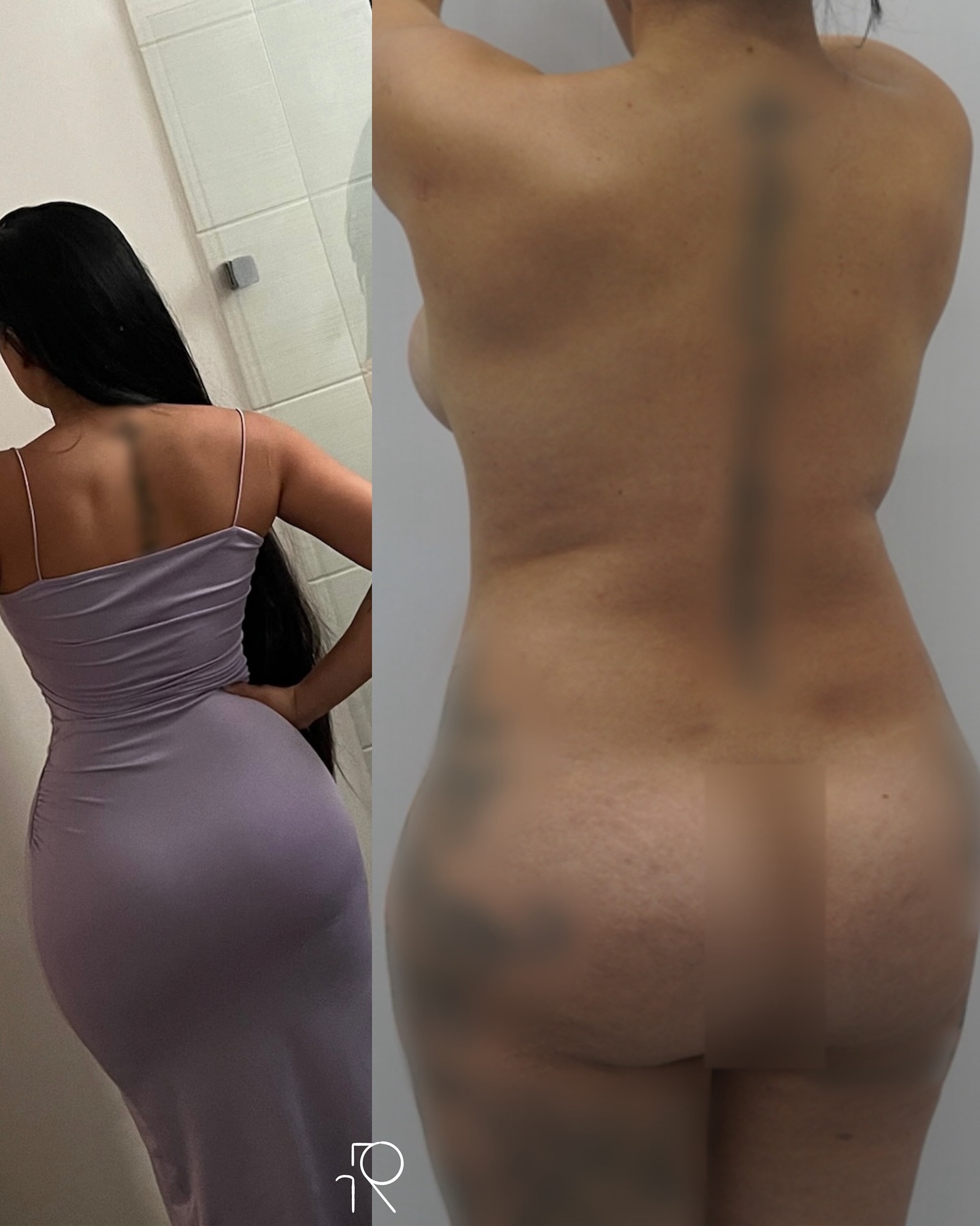 Hermoso resultado de remodelación costal (ribxcar) + lipoescultura 360° ✨ Agredecemos a nuestra paciente por compartirnos sus fotos