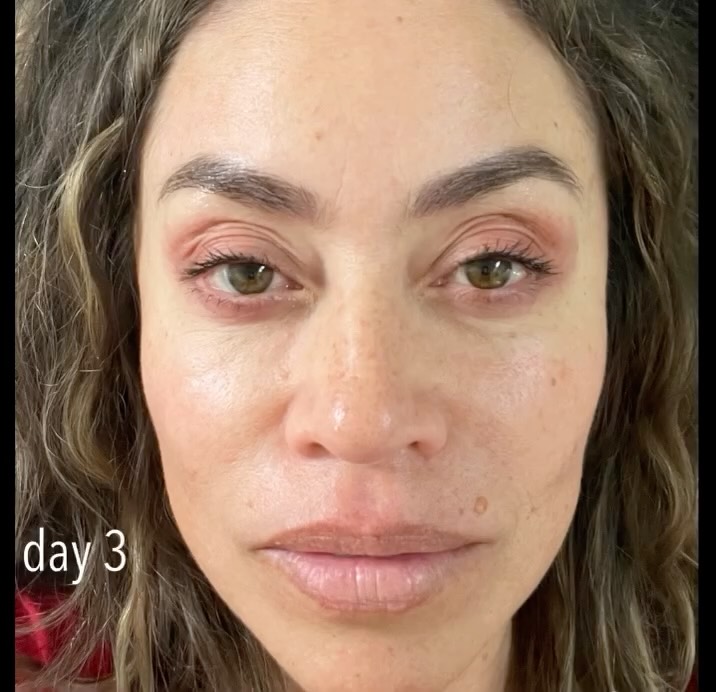 Her skin looks amazing after #microneedling with #PRP, one of her favorite treatments.
This procedure starts with numbing the skin, followed by drawing a small amount of the patient’s blood to process into platelet-rich plasma (PRP). A microneedling device is then used to create tiny punctures in the skin, and the PRP is applied topically and massaged into the micro-channels to stimulate collagen production. The procedure takes about an hour and has a short recovery time, typically 1-2 days of mild redness.
Free consultations 📞 239-777-5002
.
.
.
.
#prp #microneedling #skingoals #naplesflorida #medspanaples #healthyskin #goodbyeoldskin #wifey #glowingskin