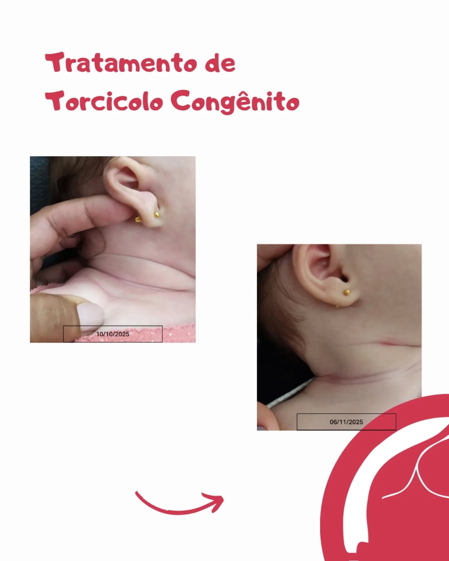 A cada sessão vemos um novo avanço — e com apenas 5 encontros os resultados já nos enchem de alegria!
Seguimos com o Método De Setti @carolinadesetti e todo o cuidado da tia Ma @fisiomartha_bbeatriz.
Dra. Martha Batista Beatriz
CREFITO 3 337902-F
#fisioterapia #fisioterapiapediatrica #fisioterapianeuropediatrica #metododesetti
#assimetriacraniana #torcicolocongenito