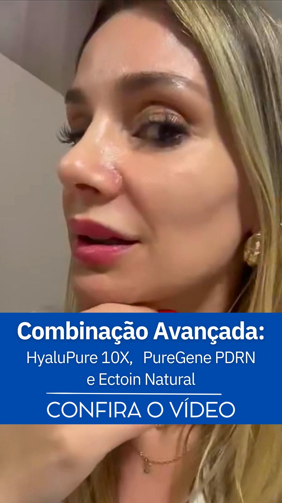 Combinação Avançada: Regeneração, Hidratação Multinível e Proteção Celular
A sinergia entre PureGene PDRN, HyaluPure 10X e Ectoin Natural entrega resultados visíveis em poucas horas, com melhora de viço, textura e hidratação já na primeira aplicação.
Essa formulação cosmecêutica de alta performance atua em:
• Regeneração tecidual e bioestimulação dérmica
• Hidratação tridimensional com efeito preenchedor imediato
• Redução de rugas finas e melhora da elasticidade
• Uniformização do tom e controle de inflamação
• Recuperação da barreira cutânea
• Proteção celular contra a luz UV, luz azul e poluição global.
Ativos e Funções:
• PureGene PDRN – estimula colágeno I e III, reativa fibroblastos e promove reparação do DNA, com melhora de textura em 12–24h.
• HyaluPure 10X – combina 10 pesos moleculares de ácidos hialurônicos, promove hidratação imediata, formação de filme protetor e restauração da função barreira.
• Ectoin Natural – extremólito celular que protege contra estresse oxidativo, reduz TEWL (perda de água transepidérmica), inflamação, melhora elasticidade e luminosidade.
Dúvidas Frequentes:
• Quando aparecem os primeiros resultados?
Em poucas horas, com intensificação perceptível entre 3 e 7 dias.
• É indicada para recuperação rápida da pele?
Sim — ideal para peles fragilizadas, desvitalizadas ou pós-procedimento.
• Formatos ideais:
Séruns noturnos, boosters calmantes e máscaras hidratantes de recuperação intensiva.
Fale conosco Tel/Wpp: (51) 3398-3637
#PureKemika #BioativosDeAltaPerformance #puregenepdrn #HyaluPure10X #EctoinNatural #Skincare #CosméticaAvançada #PeleSaudável #Dermocosmético #glassskin #bitop_ag