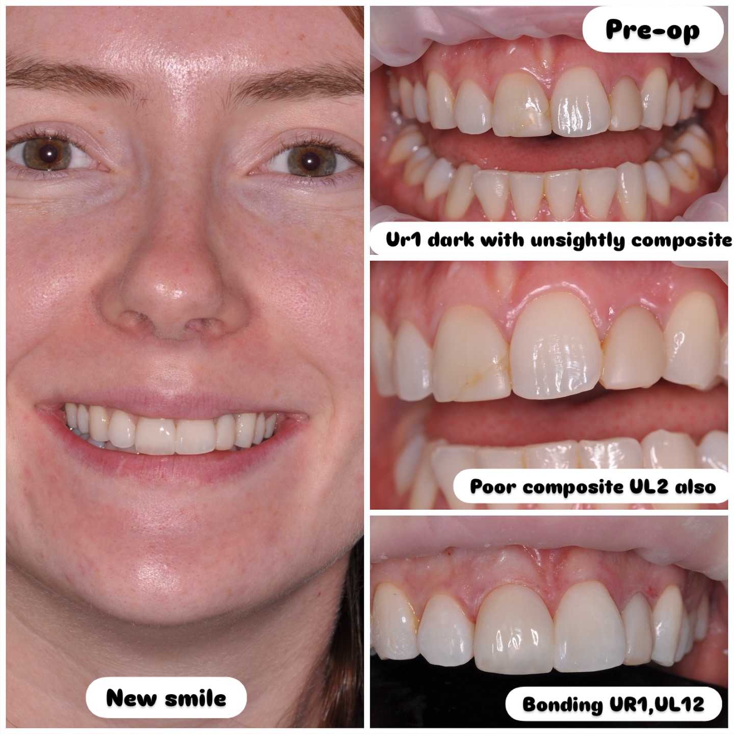 Composite bonding on my incredible patient @bethfs_ . Beth attended with a dark UR1 with unsightly composites and poor appearance on ul2 wishing to improve her smile. UR1 dx PN/chronic abscess. This transformation involved a 2 visit endo on ur1 and in/out bleaching followed by bonding on UR1 UL12. #nhs #treat #treatment #endowarrior #endodontia #rootcanaltreatment #rootcanaltherapy #endobelly #waves #waveonegold #saveteeth #endospecialist #treatyourself #simplicity #dentaltreatment #compositebonding #compositebondingmanchester #smilemakover #smilemakeover #smilemakeovermanchester