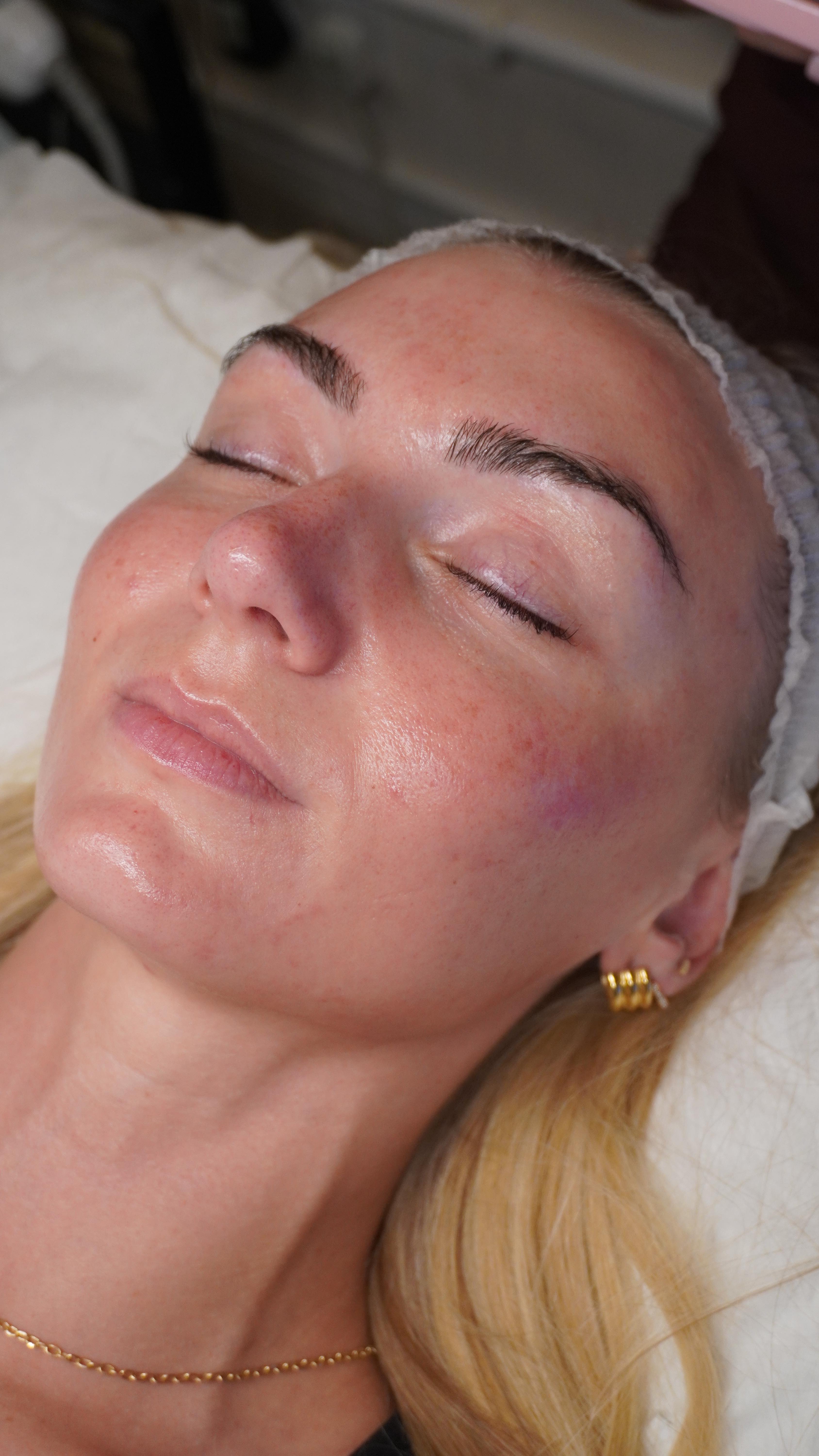 That sound 😍💧
This is part of our NEW Platinum Hyrodacial using 8 in 1 technologies for deep cleaning and anti-ageing combined with needle-free Mesotherapy for intense hydration 🙌🏼
We have extended our offer of 20% off when you book this week for the month of November 👀 DM us “HYDRO” and we will book you in! ⭐️
#woking #hyrofacial #mesotherapy #glassskin #medispa #beauty #facialsuk