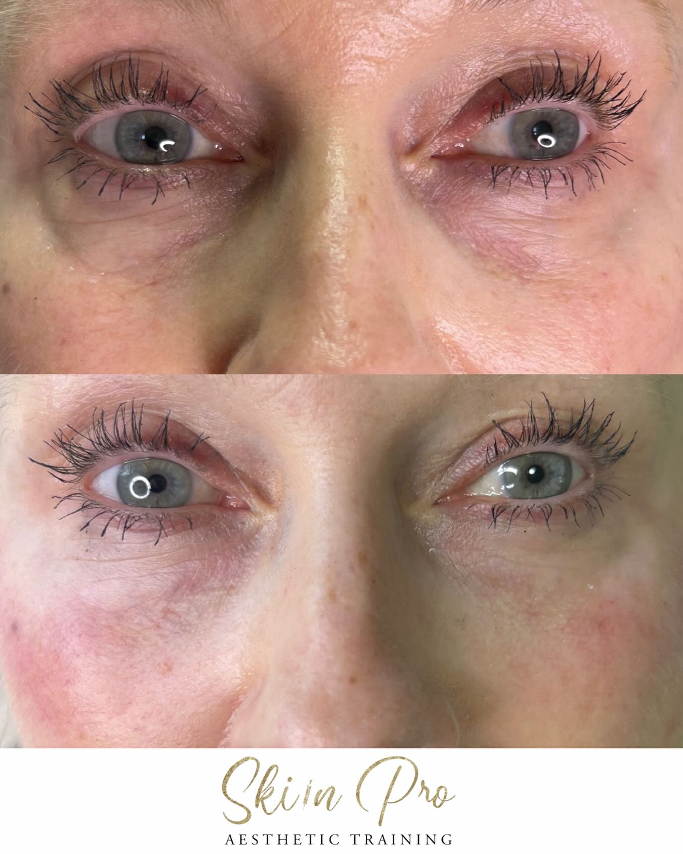 “Brighter eyes. Fresher face. Awake, revived and naturally lifted.”
✨ Tear Trough Filler Training — Master Under-Eye Rejuvenation ✨
Tear trough filler is one of the most transformative yet delicate treatments in aesthetics — and the demand is higher than ever. Our advanced training equips you with the skills, precision and anatomical expertise to safely restore volume, brighten the under-eye area and deliver natural, youthful results.
Whether you’re an experienced injector or stepping up from mid-level dermal filler training, this course teaches you the elite techniques used by top practitioners to correct hollows, soften shadows and refresh the entire eye area.
Why tear trough filler is a game-changer:
✨ Softens under-eye hollows
✨ Brightens dark circles
✨ Restores youthful volume
✨ Creates a refreshed, awake appearance
✨ Reduces the look of tiredness
✨ Boosts client confidence with subtle, natural results
✨ High-value, high-demand treatment for your clinic
Train with us and master one of the most requested advanced filler techniques with complete confidence, safety and precision.
#teartroughfillertraining #aestheticpractitioner #dermalfillertraining #aesthetictrainingacademy #aestheticcoursesuk #undereyeyouth #cosmeticinjectoruk #aestheticsclinicuk #aestheticseducation #injectablespecialist #devon #bristol