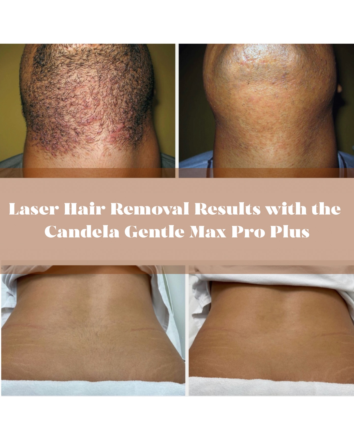Before โ After Laser Hair Removal
Goodbye ingrowns, bumps + shaving.
Hello smooth skin. ๐ #laserhairremoval