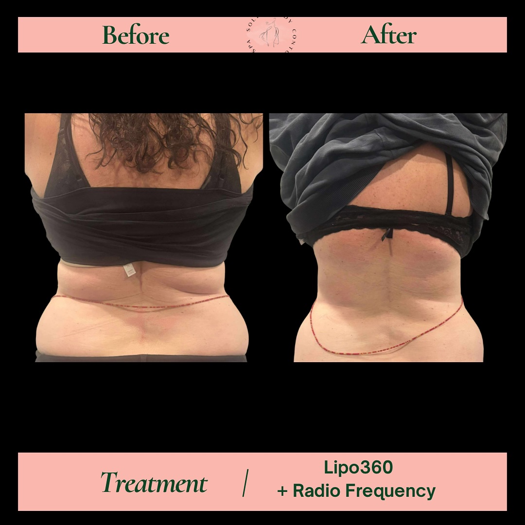 ✨ Holiday Glow-Up Season Is Here! ✨
The holidays are around the corner, and now is the perfect time to start looking and feeling your best for all those family gatherings, photos, and festive celebrations. 🎄🤍
This transformation is your reminder that confidence and radiance don’t require surgery or downtime…just the right non-invasive treatments and a little support. ✨
At SOLÉI, we blend expert body contouring with personalized wellness guidance so you can walk into every holiday moment feeling amazing from the inside out.
🌿 Non-invasive
🎁 Real, natural-looking results
🤍 Total support + customized plans
Start the season feeling healthier, happier, and holiday-photo ready.
📆 Book your FREE wellness consultation today and step into the holidays glowing! ✨