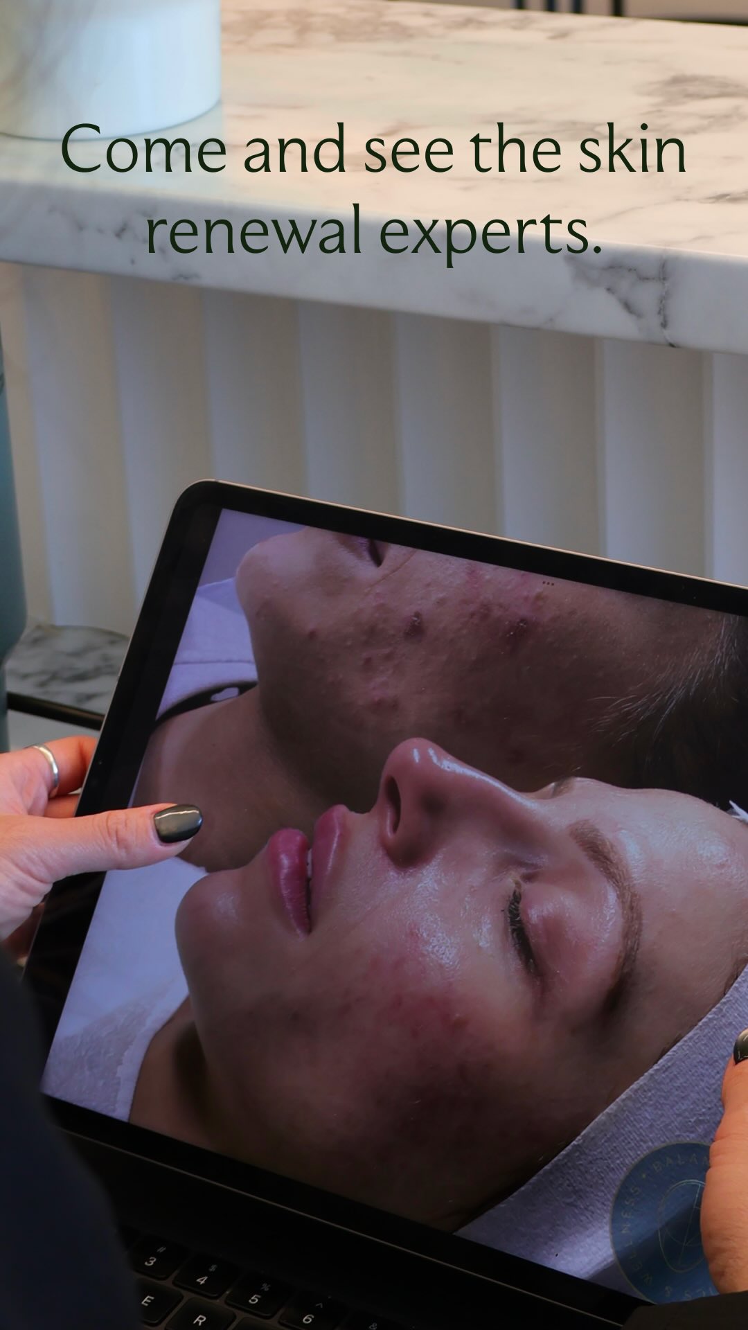 Our November mood? Fresh skin, lifted confidence, and a touch of glow… definitely not crying over how fast the year’s flown by. It’s treat-yourself season (we’ve earned it).
Don’t forget, our spring promos are still on! Only one month left to give your skin the best glow up of its life, for a fraction of the price 🤭
Link in bio besties x