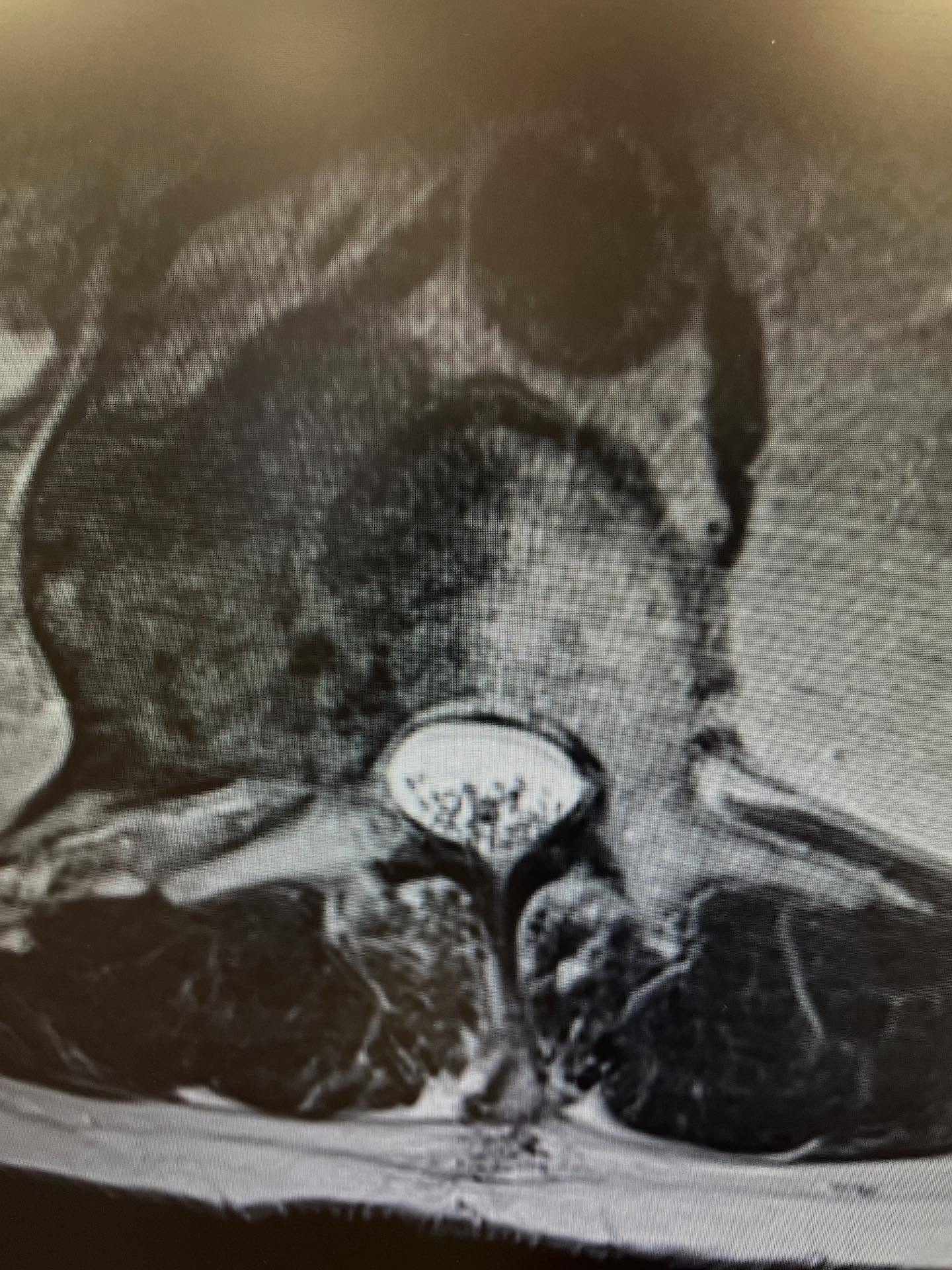 #spineoncology #spinetumor