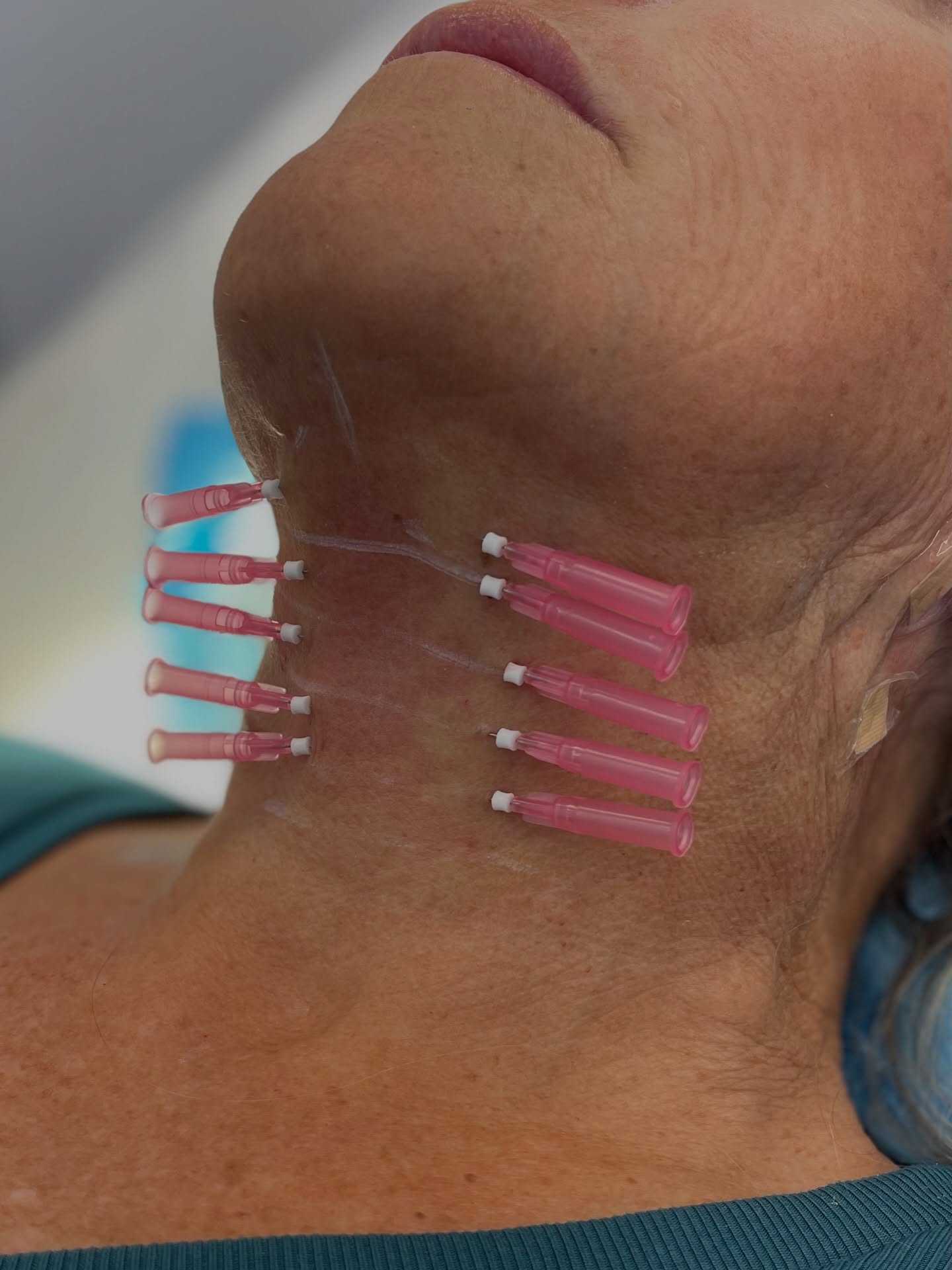 #PDO (polydioxanone) #threads. A natural appearing non-surgical, minimally invasive solution for skin rejuvenation and lifting. Benefits include:
Natural collagen stimulation, minimal downtime, reduced lines and wrinkles, long lasting, versatile, safe and customizable.
📞239-777-5002 #freeconsultations
.
.
.
.
#necklift #rejuvenate #minimallyinvasive #medicalaestheticsnaples #rudybershadskipacmpas #beautysculptmedicalaesthetics