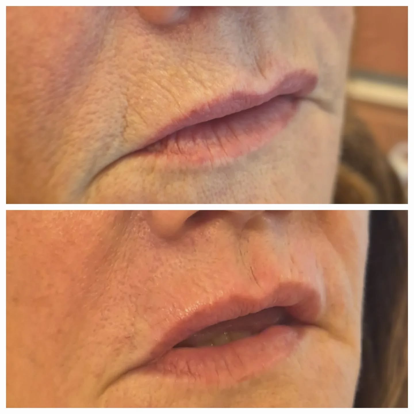 Smoker’s lines aren’t the easiest area to treat, but with the right assessment, advanced techniques, and realistic expectations, they can be improved. The goal is soft, natural rejuvenation rather than overfilling. Treatment may require a combination approach including skincare, injectables, and lifestyle changes for best results.