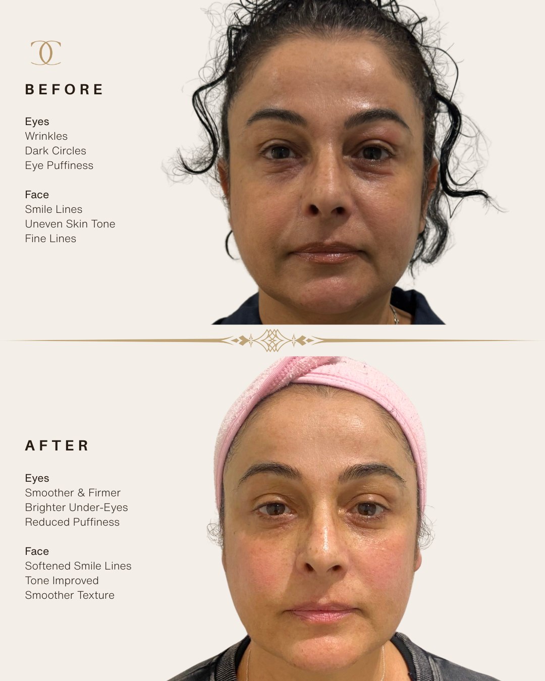 Tulin came to us feeling defeated after spending thousands elsewhere with very little improvement. After just a few sessions at Clinica, she began seeing real, gradual changes, brighter under-eyes, a softer complexion, and a more refreshed overall look. Her confidence is growing with every visit 💛
Her tailored treatment plan included:
• Bright Eye Trio Bundle (x5)
• Radio Frequency (x4)
• Skin Needling (x2)
Every skin journey is different and at Clinica, we tailor each step around you.