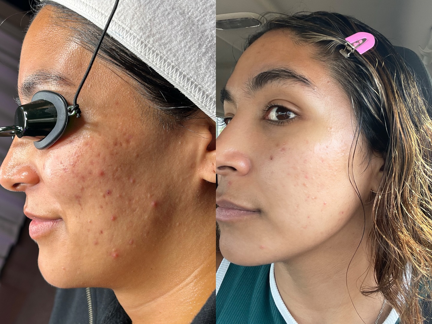 One year apart! 🥹
Same woman. different skin, different confidence. 💗
No overnight fixes.
No quick clears.
Just consistency, cellular turnover, acne management, and trust in the process.
Healing takes time.
But it’s worth every month of dedication. ✨
Let’s start with a consultation first! 🩷🥰
Comment “🤍” and I’ll DM you! 👀
#azskin#phoenixfacials#azacne#acnetrasformation#arizonaskincare#skinspecialistaz