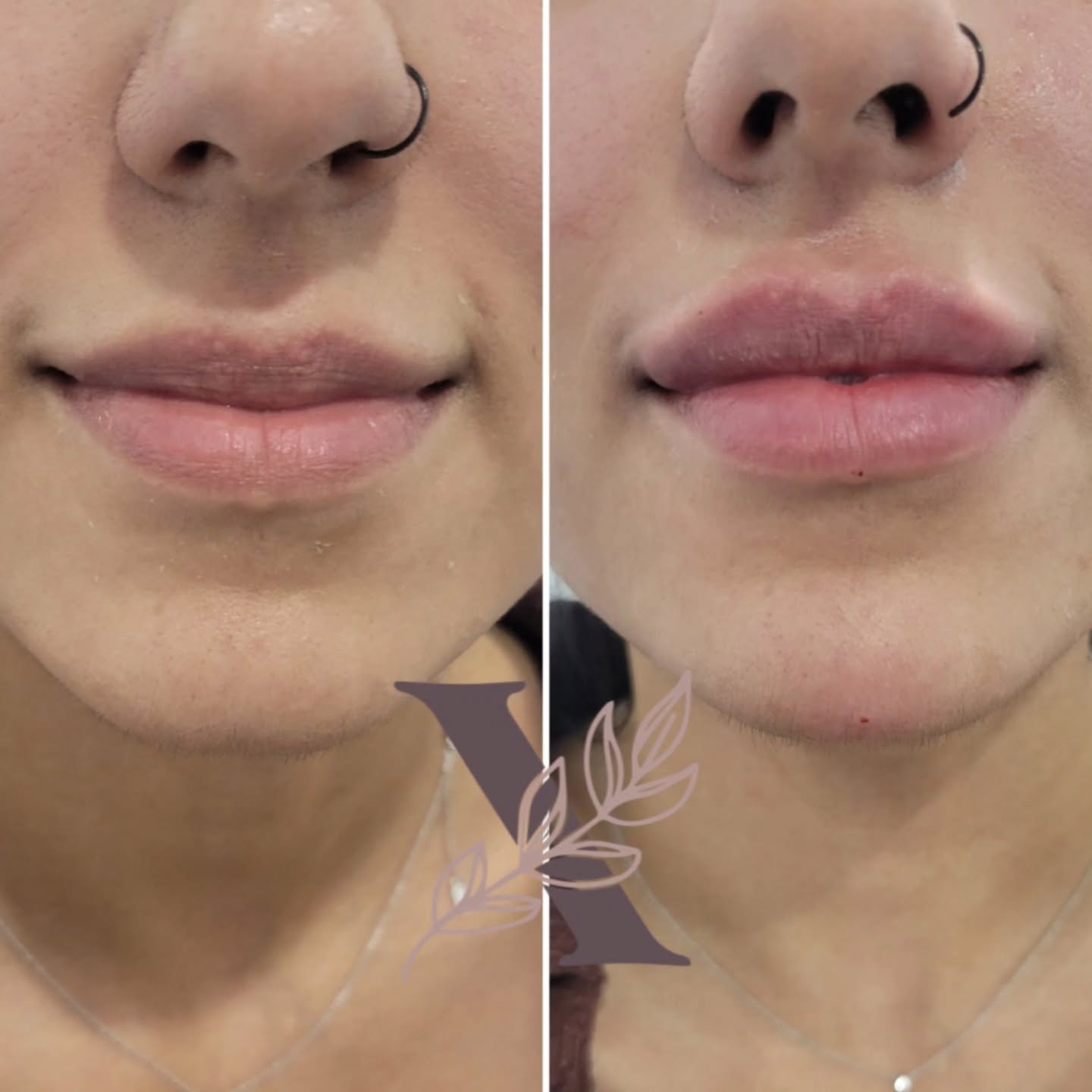 Lovely day at Beauty Xpressions Academy Ottawa with my student @thebareeditbyashley
Together, we did a beautiful, subtle lip refresh — enhanced vermilion borders, a touch of volume, and a delicate lower-lip pout for natural harmony 💋
--
#lipfillerbeforeandafter #lipfiller #dermalfillers #medicalaesthetics #aesthetics #skincare #injectables #nurseinjector💉 #npinjector #aesthetics #ottawa #windsorontario #botoxfiller #selfcare