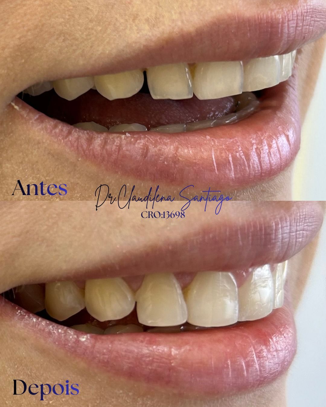 ✨Um caso cheio de charme, simples e trabalhado com muito carinho.
Queixa principal da paciente: espaço entre os dentes
(Clau , mas você é ortodontista, porque não aparelho?)
Bom, a paciente já havia utilizado aparelho e não tinha tempo de tratar a reincidiva, pois estava às vésperas do seu casamento.
Fizemos o clareamento de consultório um mês antes e dei uma leve aumentada nos quatro dentes anteriores em poucos milímetros, isso se chama acréscimos estratégicos em resina. Naturalidade é beleza.
✨Ficou uma mudança bem sútil tanto quanto harmônica.
#odontologiacombomsenso
#esteticadosorriso
#draclaudilenasantiago