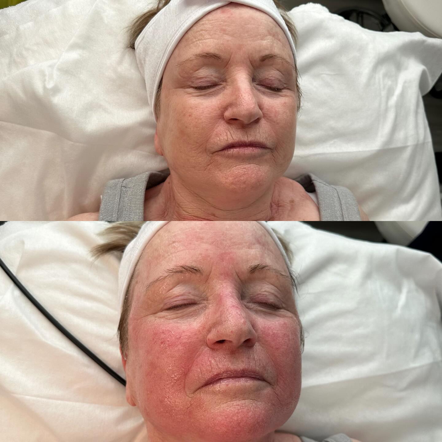 After just one treatment! Before ➡️ After ✨
Our collagen lift works by tightening and stimulating the skin to improve firmness and texture.
Perfect for dull, tired, or ageing skin 🤍