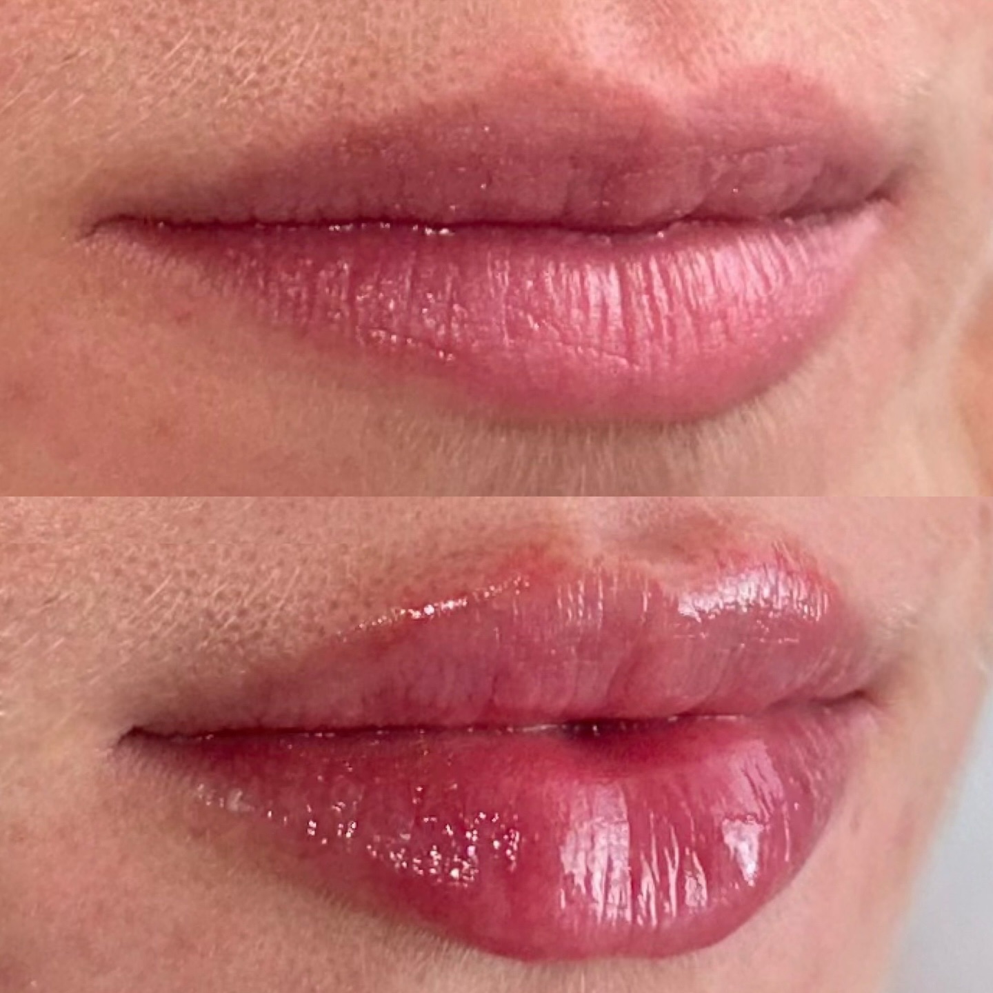 Pillowy natural looking lips using 0.5ml Restylane Kysse 🫦
#naturallipfiller #aestheticslondon #lipfillerlondon
