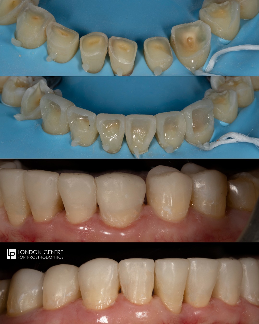 In addition to decay and gum disease, patients can suffer from tooth wear.
This wonderful patient came to see us because she was concerned about her lower teeth. They had been affected by severe tooth wear caused by an intense grinding habit. The teeth are so small and they have been worn down so much that it is not sensible to cut them down further for crowns. We have advanced materials and adhesive techniques available that allow us to build up the teeth totally additively, without anaesthetic and in one visit.
Are you concerned about the appearance and integrity of your teeth? There are always treatment options available. Let us guide you and help you to choose the best available treatment for your specific problem.
Get in touch with our team to book your appointment - we look forward to seeing you soon!
The London Centre For Prosthodontics
29 Weymouth Street
London, W1G 7DB
020 7637 4518
info@londonprosthodontics.com
Monday - Friday: 7:30am - 4:30pm
#MaryleboneDentist #LondonSmiles #HealthyTeethMarylebone #DentalCareLondon #SmileMakeover #MaryleboneOralHealth #LondonDentalExperts #CosmeticDentistry #TeethWhiteningMarylebone #EmergencyDentistLondon #MaryleboneOrthodontics #LondonDentalClinic #DentalCheckup #MaryleboneDentalCare #SmileTransformation
#LondonOralCare #MaryleboneDentalHealth #FamilyDentistLondon #TeethCleaningMarylebone #CosmeticDentistLondon #MaryleboneTeeth #LondonDentalHygiene#MaryleboneOrthodontist #OralWellnessLondon #PreventiveDentistry #MaryleboneDentalServices #LondonDentalSpecialists #MaryleboneHealthySmiles #LondonDentistry #AdvancedDentalCare