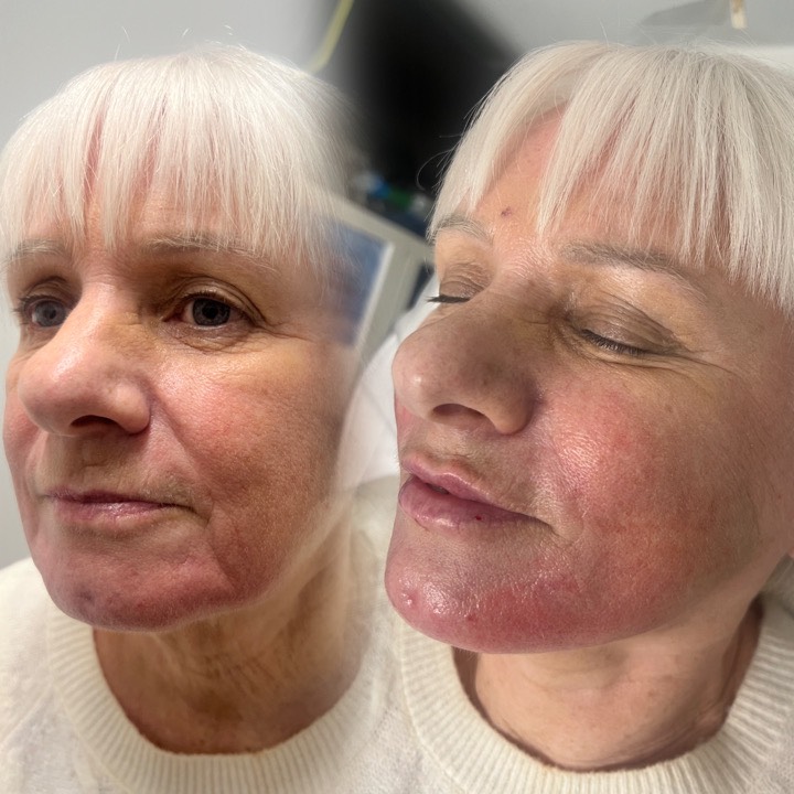✨ 4mls of Filler Transformation! ✨
Today our beautiful client had 4mls of expertly placed dermal filler in the:
💗 Nasolabial folds
💗 Marionette lines
💗 Chin
💗 And her very first lip filler!
How gorgeous does she look?!! 😍
Subtle, balanced and beautifully refreshed – exactly how we love it at The Beauty Lab North East.
✨ Book in with Rachel – our Senior Aesthetics Practitioner
Rachel is available at BOTH locations: Felling & South Shields 💉
#TheBeautyLabNorthEast #DermalFillers #LipFiller #NasolabialFoldFiller #MarionetteLines #ChinFiller #AestheticsNorthEast #NaturalResults #FillerTransformation #BeautyClinic #AestheticPractitioner #Felling #SouthShields #ConfidenceBoost #glowup