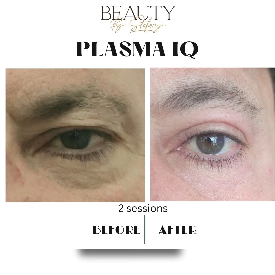 ✨ Say goodbye to sagging skin! Our Plasma IQ Pen is here to tighten and rejuvenate your upper eyelids. Experience a youthful glow and boost your confidence! 💖 Book your appointment today! #EyelidTightening #YouthfulSkin #PlasmaIQ
