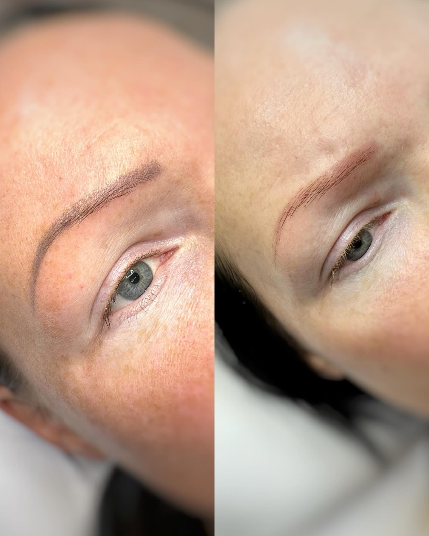 Alma laserilla voidaan poistaa tai vaalentaa vanhaa kulmapigmentointia. Tässä kuvassa on tehty yksi poistokerta ja asiakkaan toiveena oli vaalentaa kulmia uutta pigmentointia varten.
Jos pigmentointikertoja on vuosien mittaan useampi, väri kerrostuu ihoon ja lopputulos on usein liian harmahtava tai liian tumma.
Laserpoistolla kulmista saa taas miellyttävämmät! Turhaan ei tarvitse "kärsiä", jos kulmat ei enää miellytä vuosien päästä.