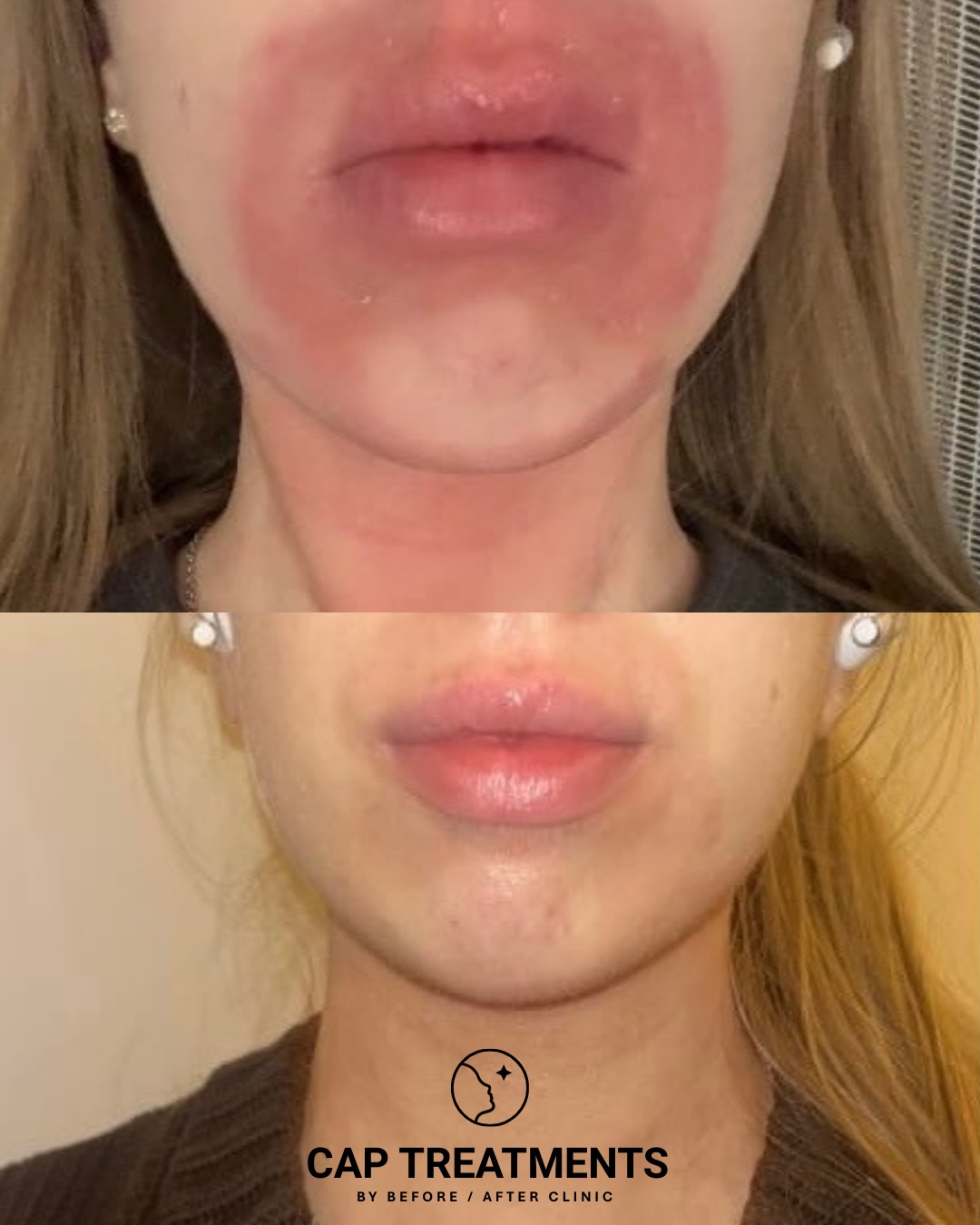 Frihet 🌸 Vi låter kunden själv berätta känslan genom hennes värmande recension 💕
Swipe ➡️
#tsw #topicalsteroidwithdrawal #eksem #topicalsteroidwithdrawal