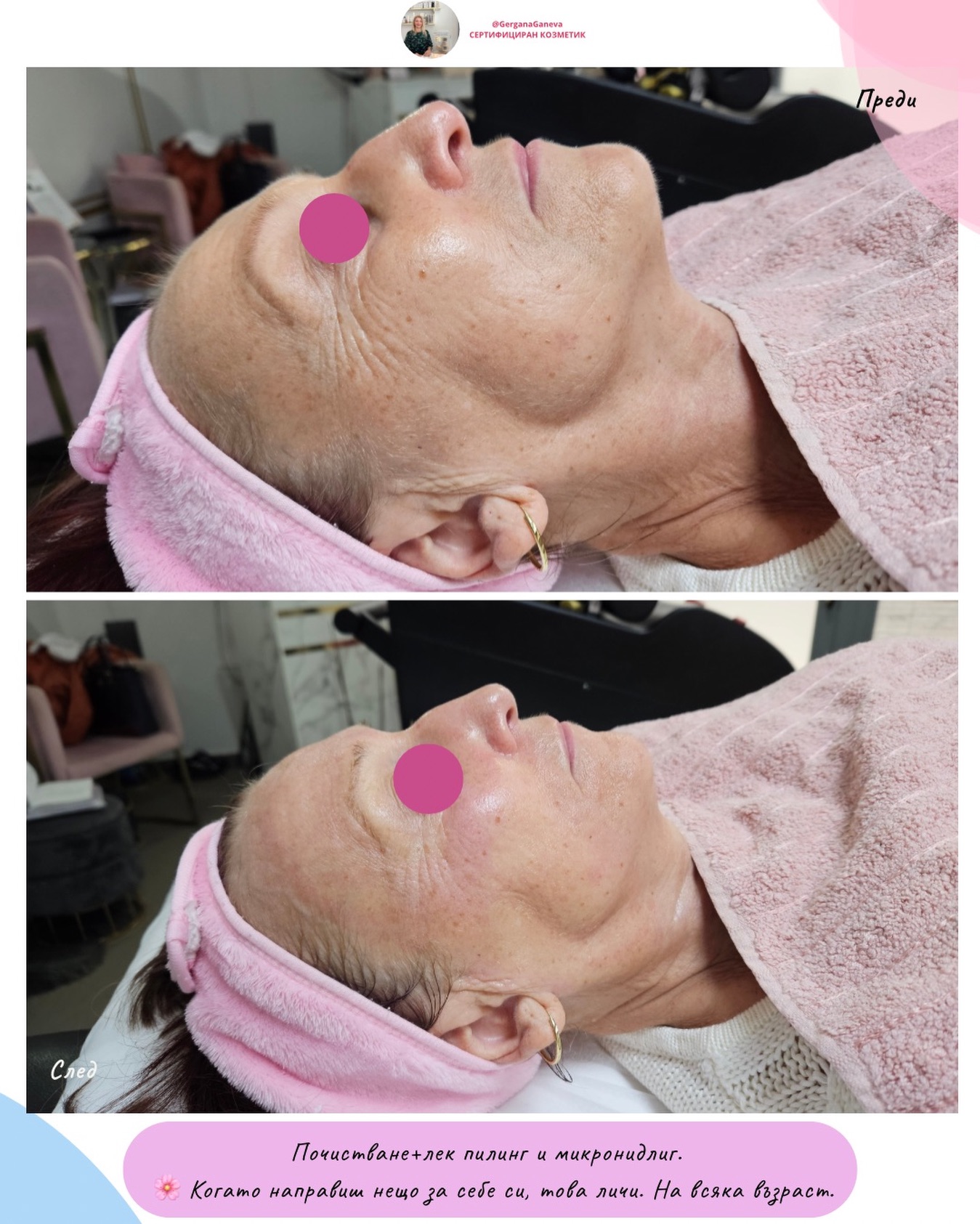 ✨ Възрастта не е извинение. Тя е само число.
Резултатът е видим – блясък, свежест, стегнатост, живот в кожата. Всяка грижа се отблагодаря, това е пример.
Искам да ви напомня нещо важно:
🌸 Когато направиш нещо за себе си, това личи. На всяка възраст. Няма твърде късно. Няма “не е за мен”. Има само решение да се почувстваш по-свежа, по-уверена и по-сияеща.
Сега е най-подходящият момент – наближават празниците. 🎁 Процедура за подмладяване е не просто подарък – това е жест на грижа.
Към теб самата или към жена, която обичаш.
Ако искаш и ти да видиш такава трансформация – пиши ми. Красивата кожа няма възраст. А сиянието е избор. ✨💗
