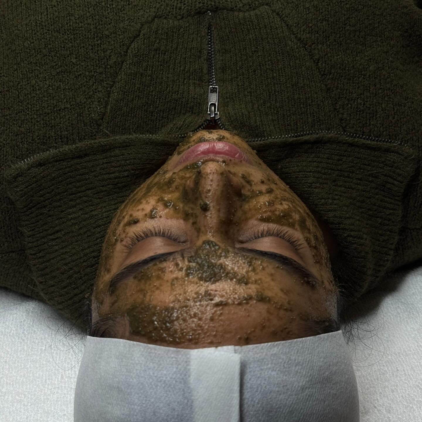 Say hello to fresh, radiant, reset skin.
The Zeena Algae Peel is one of my favourite treatments for clients who want visible results without the downtime. This peel uses natural micro-algae to gently resurface the skin, boost cellular turnover, tighten pores, and stimulate collagen — all while keeping the barrier happy and supported.
What I love most is how quickly the glow shows up: smoother texture, brighter tone, and that healthy, dewy finish that looks good with or without makeup. Whether you’re targeting fine lines, congestion, dullness, or just craving a deep refresh, the algae peel delivers a beautiful, natural radiance.
Your glow-up starts at the cellular level… and the results speak for themselves.
#ZeenaAlgaePeel #AlgaePeel #ZeenaGlow #GlassSkin #SkinRevival #SkinRenewal #HealthySkinJourney #ClinicTreatment #GlowFromWithin #SkincareRoutine #ProfessionalSkincare #SkinTransformation #hauteesthetics #surrey #delta #vancouver #skincareroutineisamust #skinglow #peels