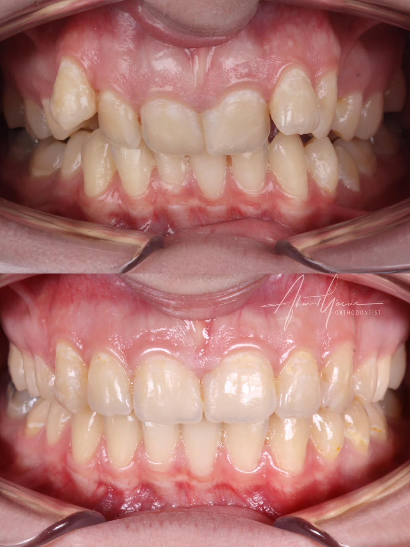 Our clinic is authorized by the Ministry of Health of the Republic of Türkiye for International Health Tourism. All patients have been informed and have provided consent for the use of their photographs on our social media platforms. All content shared on social media is intended to inform patients about procedures and should not be perceived as advertising. Outcomes of any surgical or interventional treatment may vary from person to person. It is recommended to consult your physician for detailed information before undergoing any procedure.
.
.
.
#ortodonti #ortodontist #bursa #bursaortodonti #bursaortodontist #bursaortodontiuzmanı #orthodontics #braces #teltedavisi #dişteli #orthognathicsurgery #invisalign #diş #şeffafplak #lingualortodonti #dişteli #çeneameliyatı #selfligating #kapaklıbraket #gülüştasarımı #dişhekimi #dentistry #photography #estetik #dentalart #ahmetyasar #drahmetyasar