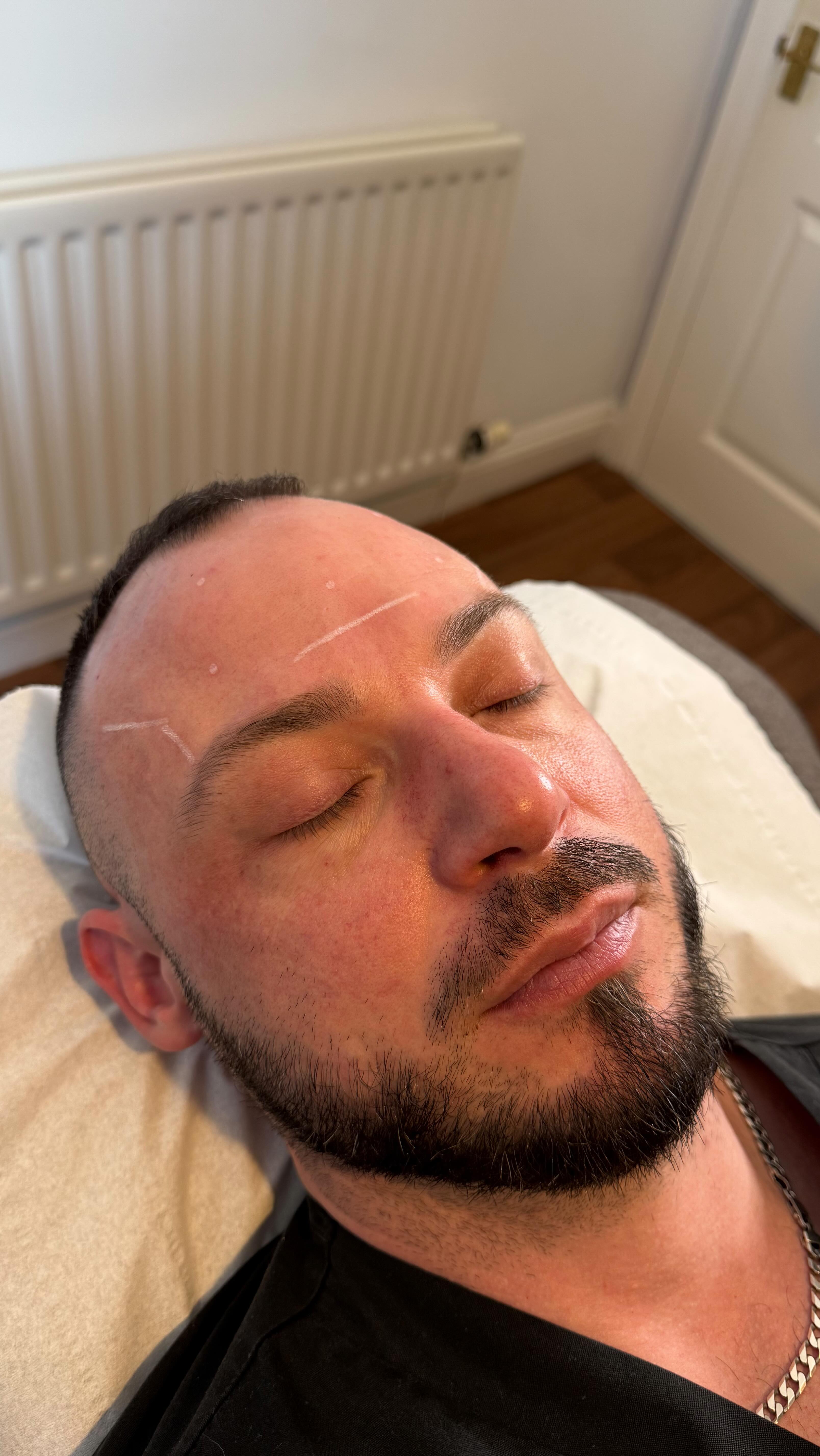 2 weeks âtil Christmas⌠and yes, thereâs still time for anti-wrinkle â¨
Botox takes up to 14 days to fully settle, so if you want smoother skin, softened lines, and a fresher look just in time for the festivities - nowâs the moment to book.
Perfect for:
â Forehead lines
â Frown lines (between brows)
â Crowâs feet
Appointments still available here & thereâŚbut not for long.
DM to book or head to the website to book đ
#antiwrinklecheltenham #botoxbeforechristmas #nineteenbeauty #smoothskinseason #cheltenhamaesthetics