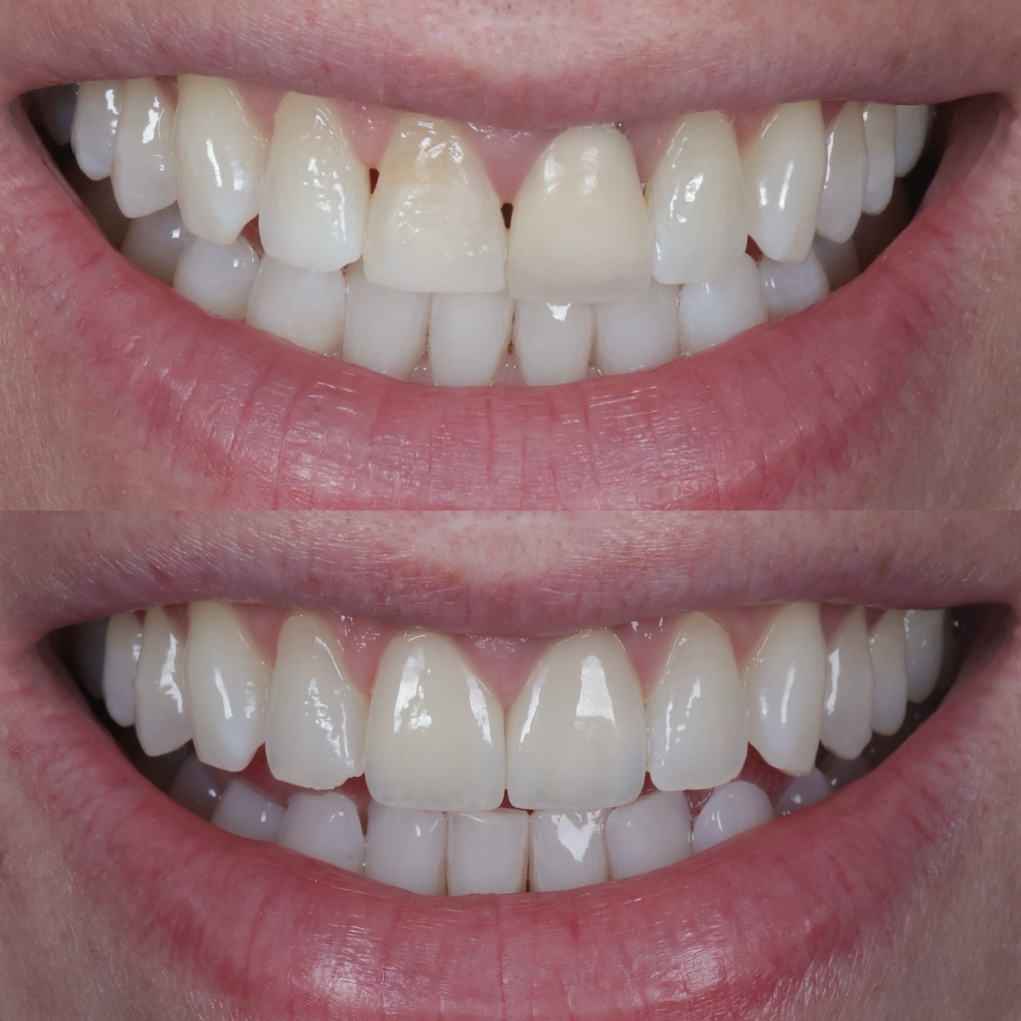 Two front teeth that never quite matched or fit in — different lengths, different colours, and not blending with the rest of the smile.
We decided on a replacement porcelain crown and a single porcelain veneer, using special preparation designs to close small black triangles and create a smoother, more natural look 🤝
Matching natural shades, translucency and contours is one of the most challenging parts of cosmetic dentistry — but this transformation was worth it!
A great collaboration with @fineartdentalstudio_oraldesign 👊🏽