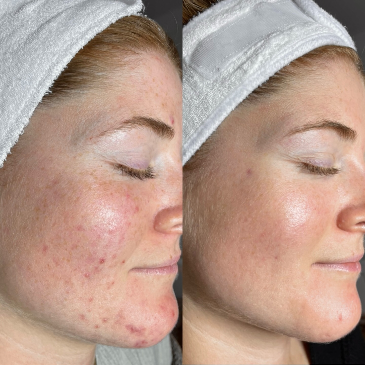 Jede sichtbare Hautveränderung hat eine Ursache. Und nur wenn diese klar identifiziert ist, können Behandlungen wirklich greifen.
Deshalb beginnt jeder Hautprozess bei uns mit einer präzisen Analyse und einer auf deine Haut abgestimmten Strategie.
Das Ergebnis in diesem Vorher–Nachher-Vergleich zeigt, was möglich ist, wenn professionelle Behandlungen konsequent mit der richtigen Heimpflege kombiniert werden.
Haut funktioniert wie Training: Ohne Struktur, Wiederholung und die passenden „Nährstoffe“ bleibt der Erfolg aus.
Wer bereit ist, die Ursache anzugehen, sieht auch die Veränderung.
Hier beginnt dein Weg zu stabiler, klarer und makelloser Haut.
Buche jetzt deine persönliche Hautanalyse und starte deine Hautreise mit uns.
#kosmetikmünchen #münchenaltstadt #hydrafacialmünchen #microneedlingmünchen #gesichtspflegemünchen #hautpflegemünchen