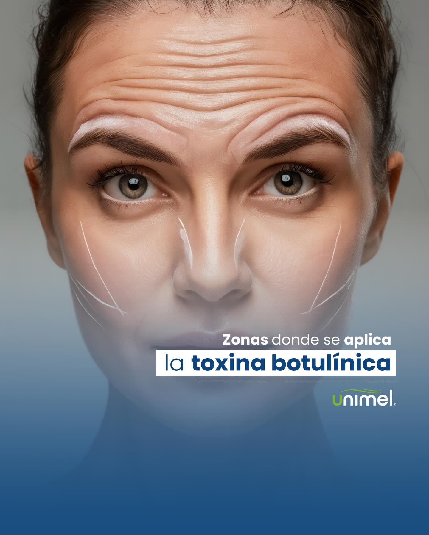 Cada zona del rostro y del cuerpo responde diferente a la toxina, y saber dónde aplicarla —y cuánto— marca la diferencia entre un resultado natural y uno exagerado.
Por eso es tan importante una valoración médica cuidadosa, coherente y enfocada en tu expresión: cuando hay criterio, la toxina realza tus rasgos con naturalidad.
La constancia en tu plan estético también es parte del cuidado. ✨
#BotoxVe #RostroNatural #EstéticaSegura #SaludYBelleza #Unimel