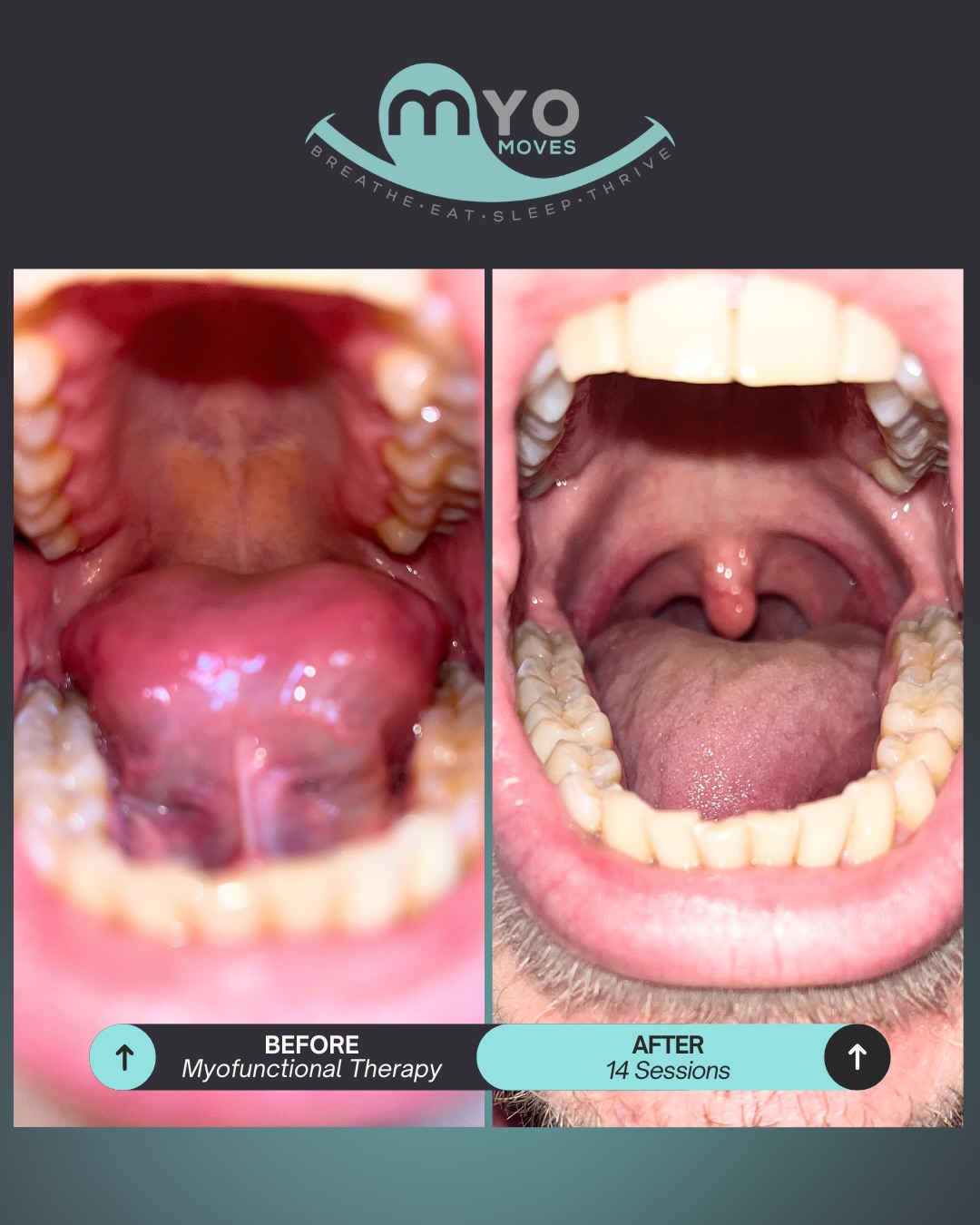 Swipe to see what 14 sessions of myofunctional therapy can do 👀⬆️
Before therapy, this patient had to physically hold his tongue down just to get a clear view of his throat (Picture 2). His tongue couldn’t lift, suction, or stabilize on its own, which impacts everything from breathing to swallowing to airway space.
After consistent myo work?
✨ More control
✨ Stronger suction
✨ Cleaner lift + better stability
✨ A visible, functional airway without using his hands
This is what happens when you retrain the muscles that support the airway! Real, measurable, life-changing progress!
If you’re curious what myofunctional therapy could look like for you (or your child), drop “YES AIRWAY” below and I’ll send you more info on how to get started with improving your airway today!
