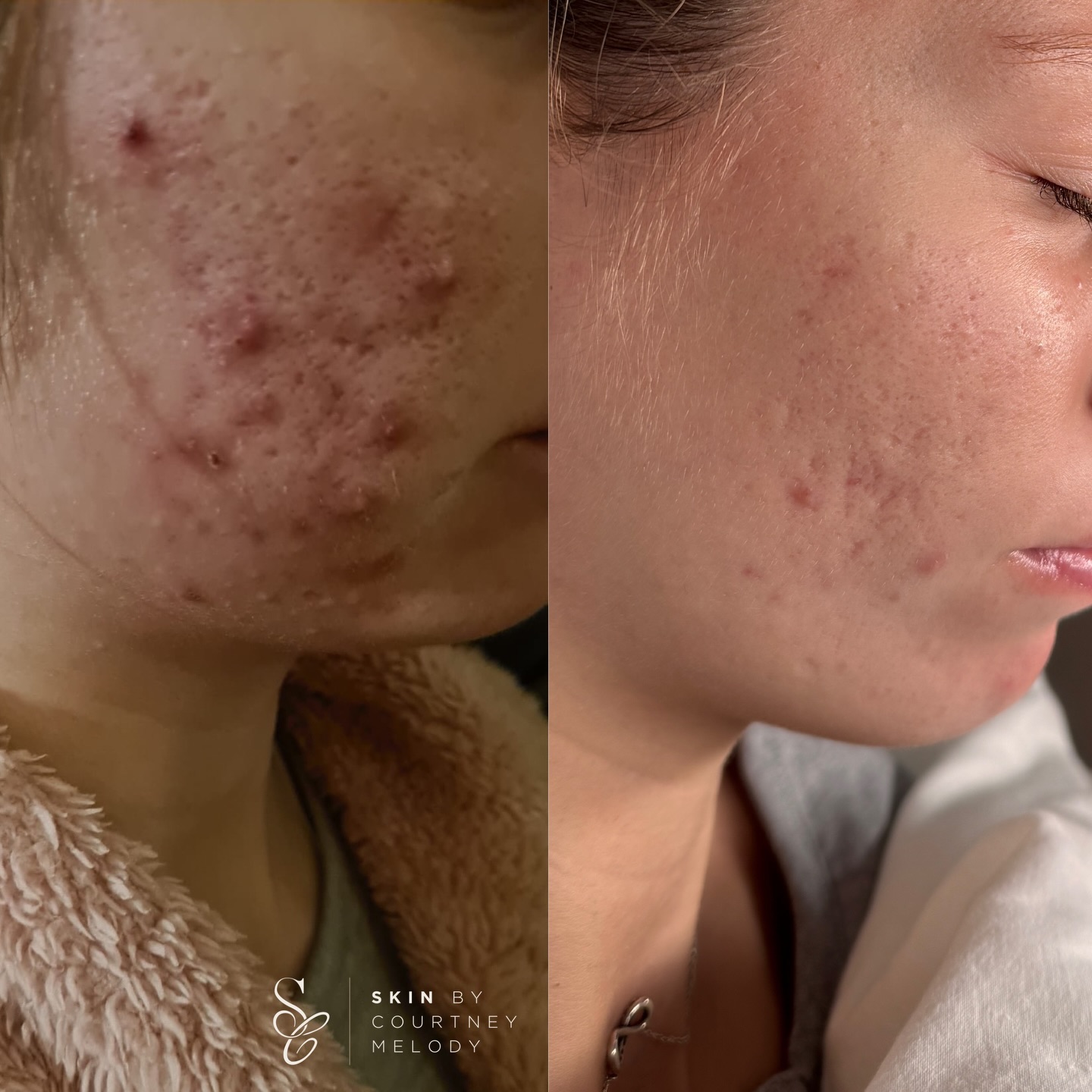 So happy to share this client’s progress 💘
On the left are the photos her mum sent me before booking, and on the right is her skin after just five treatments.
When she first came to me, her skin was highly reactive and completely out of balance. She was experiencing congestion, closed comedones and cystic breakouts, a combination that often points to an impaired barrier and underlying internal stressors.
We took a full 360 approach (as always!) looking at her lifestyle, nutrition and daily habits to support her skin from the inside out. Alongside this, we’ve been carrying out monthly bespoke young-skin treatments, keeping the focus on hydration, barrier repair and restoring homeostasis. Over time, her skin has become noticeably more resilient, and her overall system has responded beautifully.
My teen clients are always so dedicated, and their consistency really does accelerate their results.
I’m incredibly proud of her progress so far. Once she turns 18 in a few months, we’ll be able to begin SkinPen microneedling to continue building on skin health but focussing more on supporting skin regeneration by activating fibroblasts, which play a key role in repairing and remodelling scar tissue 🧬