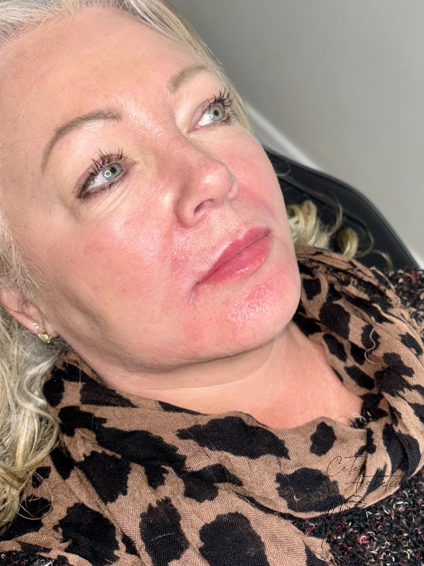 Dermal Filler Package 💉
Instead of focusing on volume, our goal was to refine the lower face with gentle, strategic support.
Targeted filler to the lips, chin and peri-oral area softened lines and lifted the overall appearance. Keeping it subtle, natural, and true to her features
Our dermal filler packages currently have £100 off as part of our festive discounts.
You can book now and schedule your appointment for any date — the discount will still apply as long as the booking is made during the offer period.
December and January appointments are already almost full, so early booking is recommended.
✨ Reserve your slot online at www.ceteaesthetics.co.uk
#dermalfiller #scunthorpebusiness #aestheticsclinic