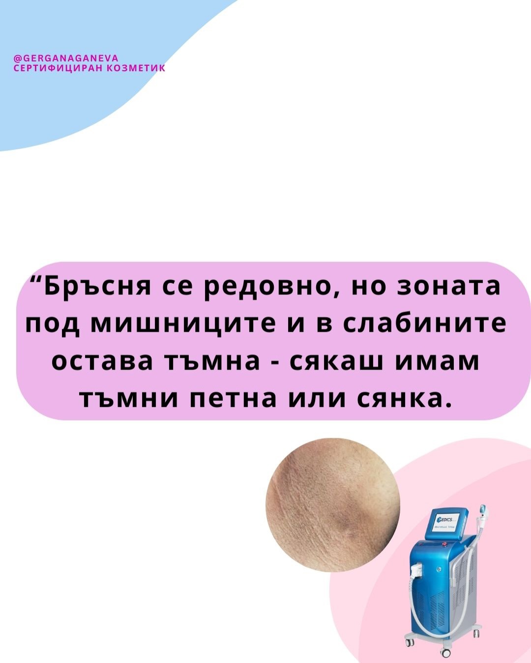 ❗️Имаш тъмни петна под мишниците или в бикини зоната… дори след бръснене и изглежда като „сянка“, мръсно петно или посиняване…
Причината 👇
✔️ Микро-възпаления от бръснене
✔️ Подкожни косми
✔️ Хронично раздразнение
✔️ Натрупване на меланин (потъмняване)
Лазерната епилация е най-доброто решение, защото премахва истинската причина за потъмняването - постоянните микро-възпаления от бръсненето. Когато космите спрат да растат, раздразненията изчезват, кожата се успокоява и започва да изсветлява естествено. Това е ефект, който нито бръсненето, нито кола маската могат да дадат. Запази час на лично 📩