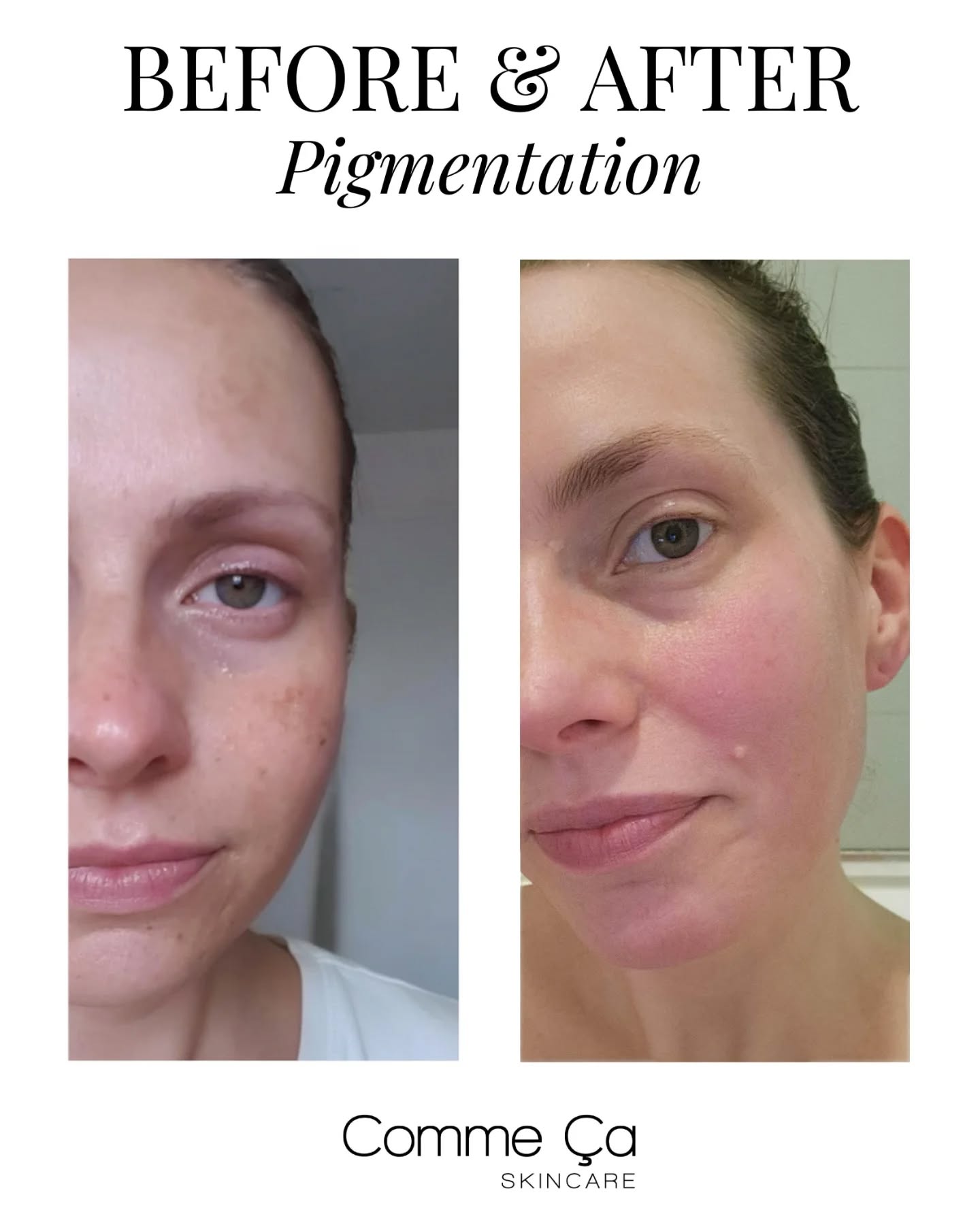 Let me start by saying… This “before” picture is not the best picture of me 😅, but it’s the only picture I still have from that time. So bear with me, because it shows how bad my skin really was.
Ten years ago I discovered pure, organic prickly pear seed oil 🌵 in Morocco. At a moment when my entire face was covered in hyperpigmentation. I had tried everything and nothing worked.
Until this 💫
Within a few months, my skin became completely even. Every trace of hyperpigmentation disappeared, and it never returned. I’ve been using this oil ever since, supported by La Vitamine C Powder, and my complexion has stayed clear and bright.
What makes La Prickly Pear Seed Oil so special is its naturally high linoleic acid content (around 65–70%), which helps to minimize the appearance of hyperpigmentation, it softens, nourishes, and supports the skin’s elasticity. But for me, its biggest gift was restoring my skin tone when nothing else did. It gave me my glow 🤍.
And because many of you asked: yes, our Black Friday Sale is still live — including 30% off La Prickly Pear Seed Oil.
Use code BF2025 at checkout.