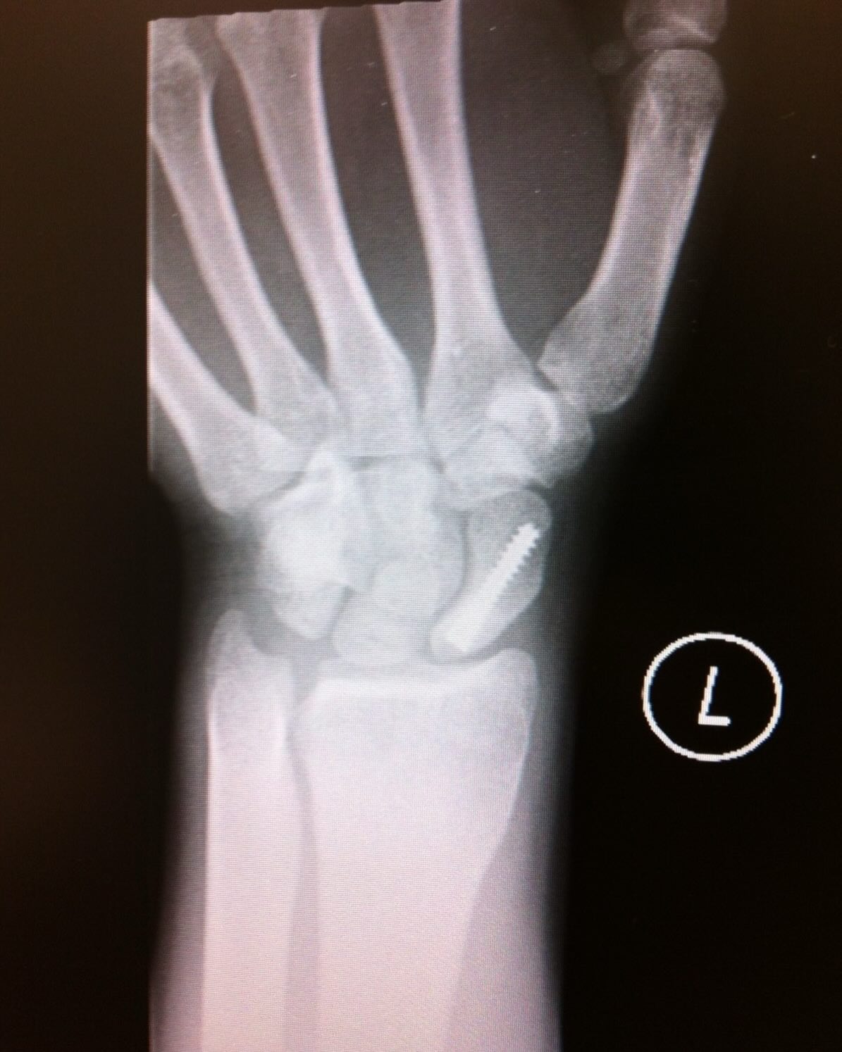 This is an x-ray of a fractured wrist repaired with a screw. This patient had some instability in her wrist and had to get surgery to repair which is sometimes necessary. However, a lot of times findings on x-ray or MRI can sound scary but are actually harmless. Around 50% of people without back pain can still have herniated discs on MRI. It’s just not causing pain. Thats why getting a full physical exam before rushing to get imaging done is always important for context. Check out the new blog post below to read more about this!
https://www.fullstridespinesport.com/post/imaging-findings
#chiro #williamsburgbrooklyn #painrelief
Chiropractor in Williamsburg, Brooklyn