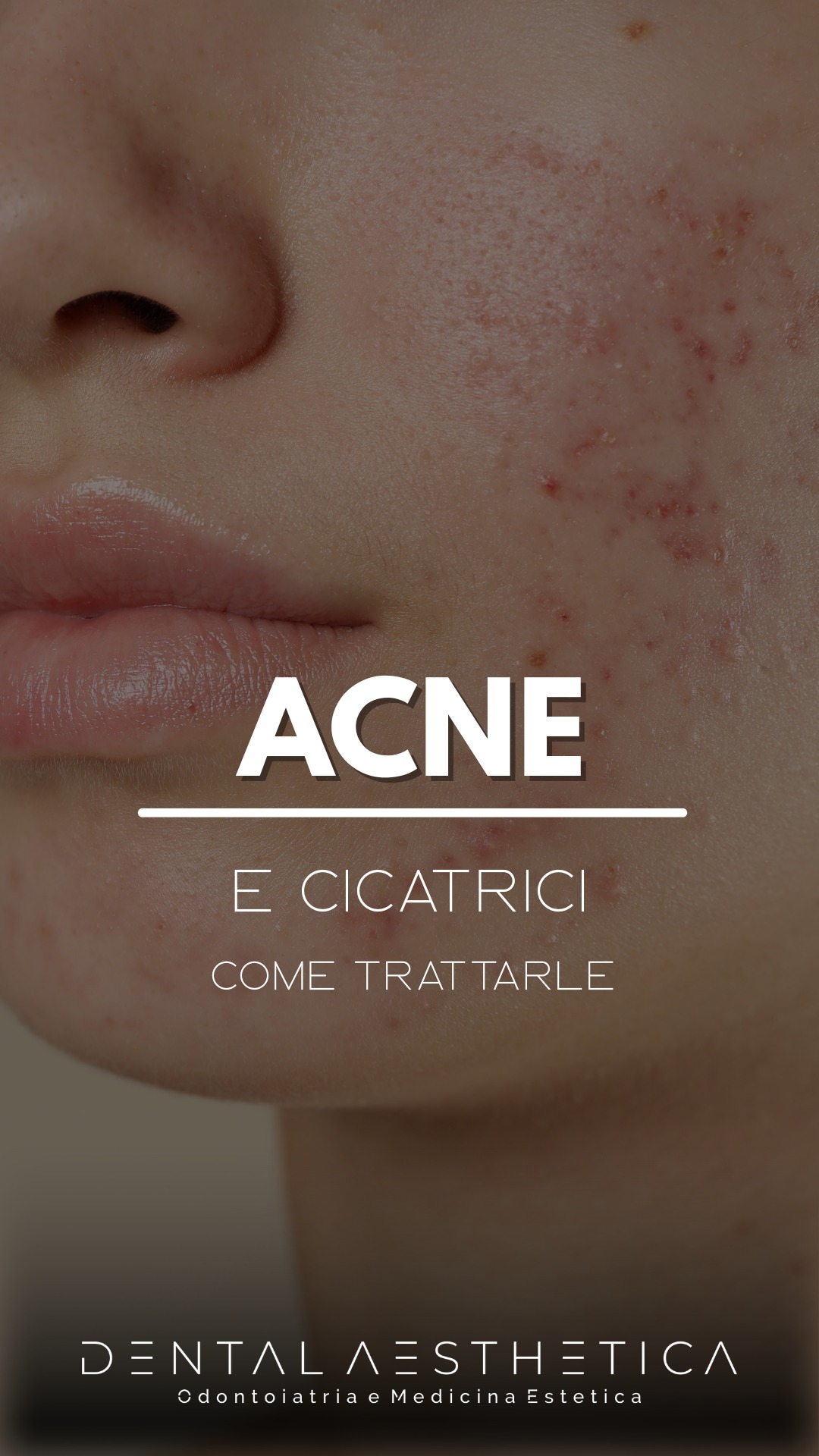 Le hai provate tutte per quei segni dell'acne, vero?
👨⚕️Le cicatrici da acne sono il risultato di un processo infiammatorio profondo della pelle: quando il tessuto si “ripara”, può farlo in modo irregolare, lasciando quei solchi o avvallamenti che conosci bene allo specchio.
Ecco come funziona un trattamento studiato per ammorbidire l’aspetto delle cicatrici da acne e rendere, finalmente, la tua pelle visivamente più uniforme.
Con un percorso graduale possiamo:
🔹lavorare in profondità stimolando nuovo collagene
🔹migliorare nel tempo la texture della pelle
🔹ridurre la percezione delle cicatrici nel quotidiano
⏱️I miglioramenti iniziano di solito a vedersi dopo 2–3 sedute. Dopo il trattamento è normale avere rossore, un po’ di gonfiore e piccole crosticine: fanno parte del processo di rigenerazione.
È importante evitare l’esposizione diretta al sole e alle lampade UV per proteggere la pelle e rispettare i tempi di guarigione.
🎯 Obiettivo del trattamento
Non parliamo di “cancellare” le cicatrici, ma di migliorarne in modo realistico l’aspetto, riducendo l’impatto visivo e lavorando sulla qualità della texture della pelle nel tempo.
📍 Dental Aesthetica – viale della Grande Muraglia 256, Roma Eur/Torrino
📲 375 88 47 069