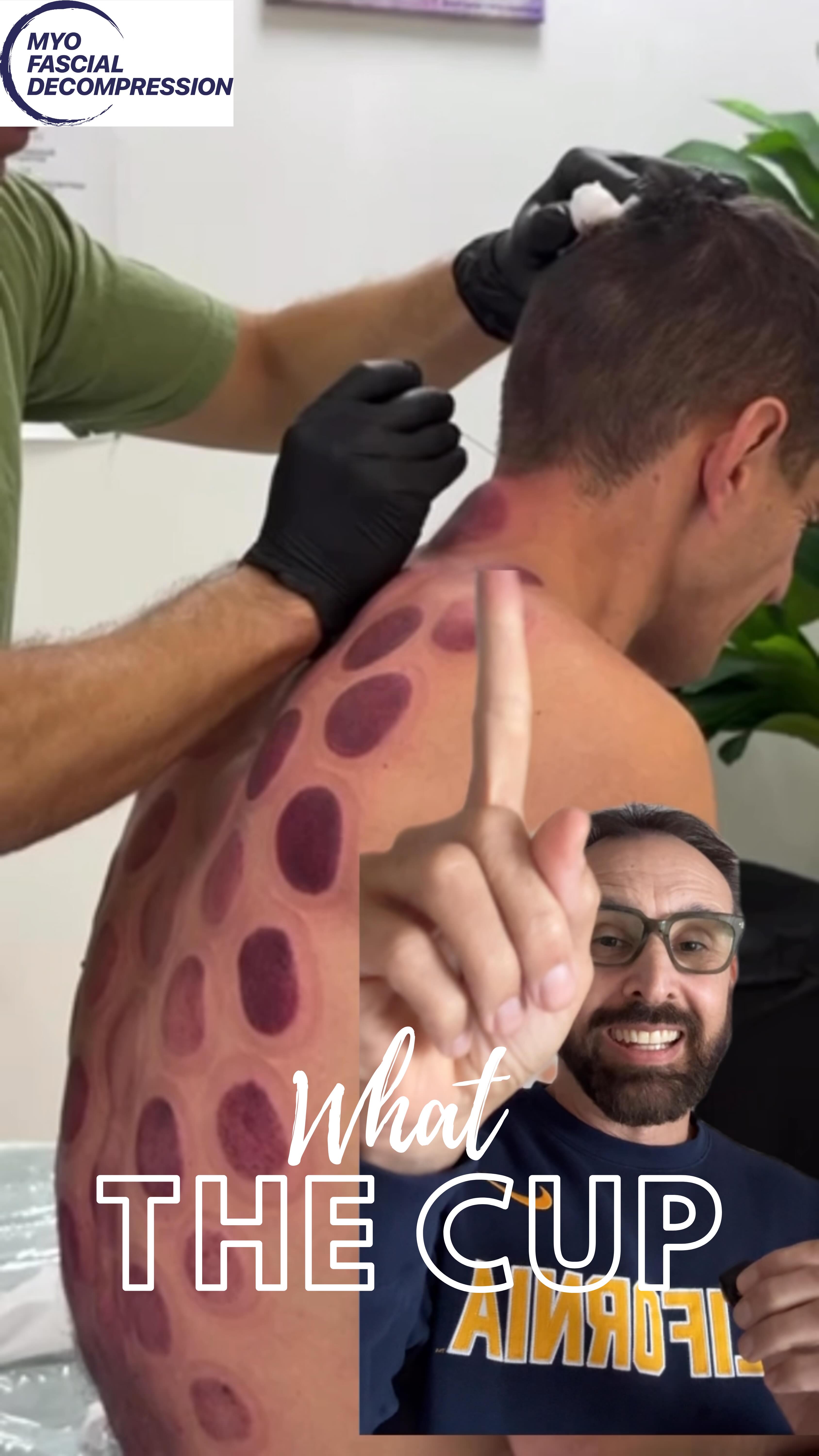 Not your average dry needling session here… more like a scalp cleansing 😱🤯 Be careful who you trust your body to with invasive interventions. It can go very badly.
#whatthecupwednesday