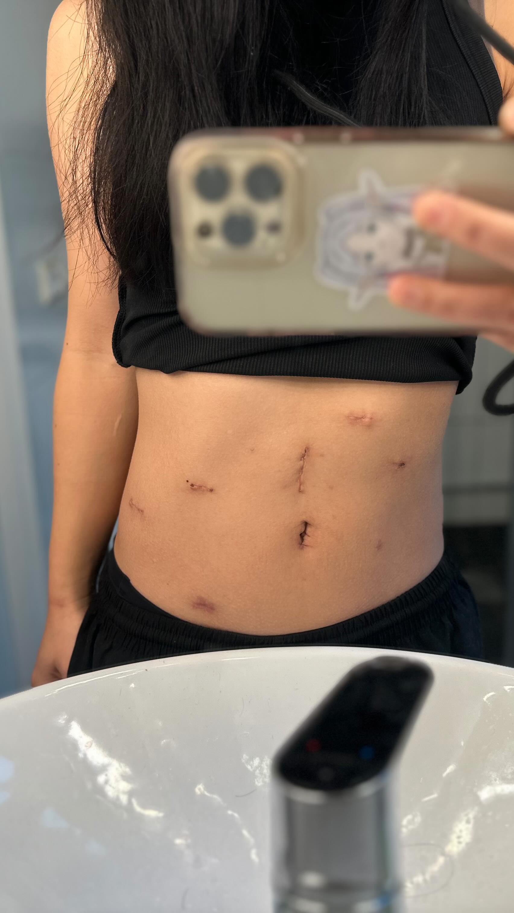 Healing Update – 27 days After My Fibroid Surgery ✨
On October 27, I underwent a robotic surgery for my uterine fibroids - 8 myoma, 972g in total!
Combined with the emergency surgery after the massive bleeding on September 28, I now have a total of 8 tiny incisions — but they’re healing✌️
My body is recovering day by day, and I’m slowly returning to full health.Thank you for all the support — I’m doing great and feeling stronger every day. 💛
And special thanks to @sodersjukhuset_regionstockholm and the Gynecology team!
Health comes first — and from now on, I’m choosing to take care of myself with kindness and priority🫶🏼
#myoma #uterinefibroids #子宮筋腫