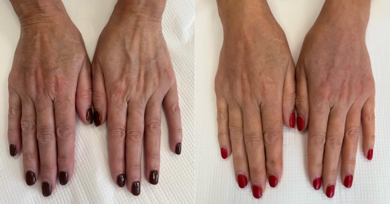 Efekt podpełnienia okolicy dłoni po upływie 1,5 miesiąca, za pomocą stymulatora - hydroksyapatytu wapnia ✨
Wyraźny efekt odmłodzenia okolicy dłoni. 🫶
Zapraszamy 🤍
📞693-101-233