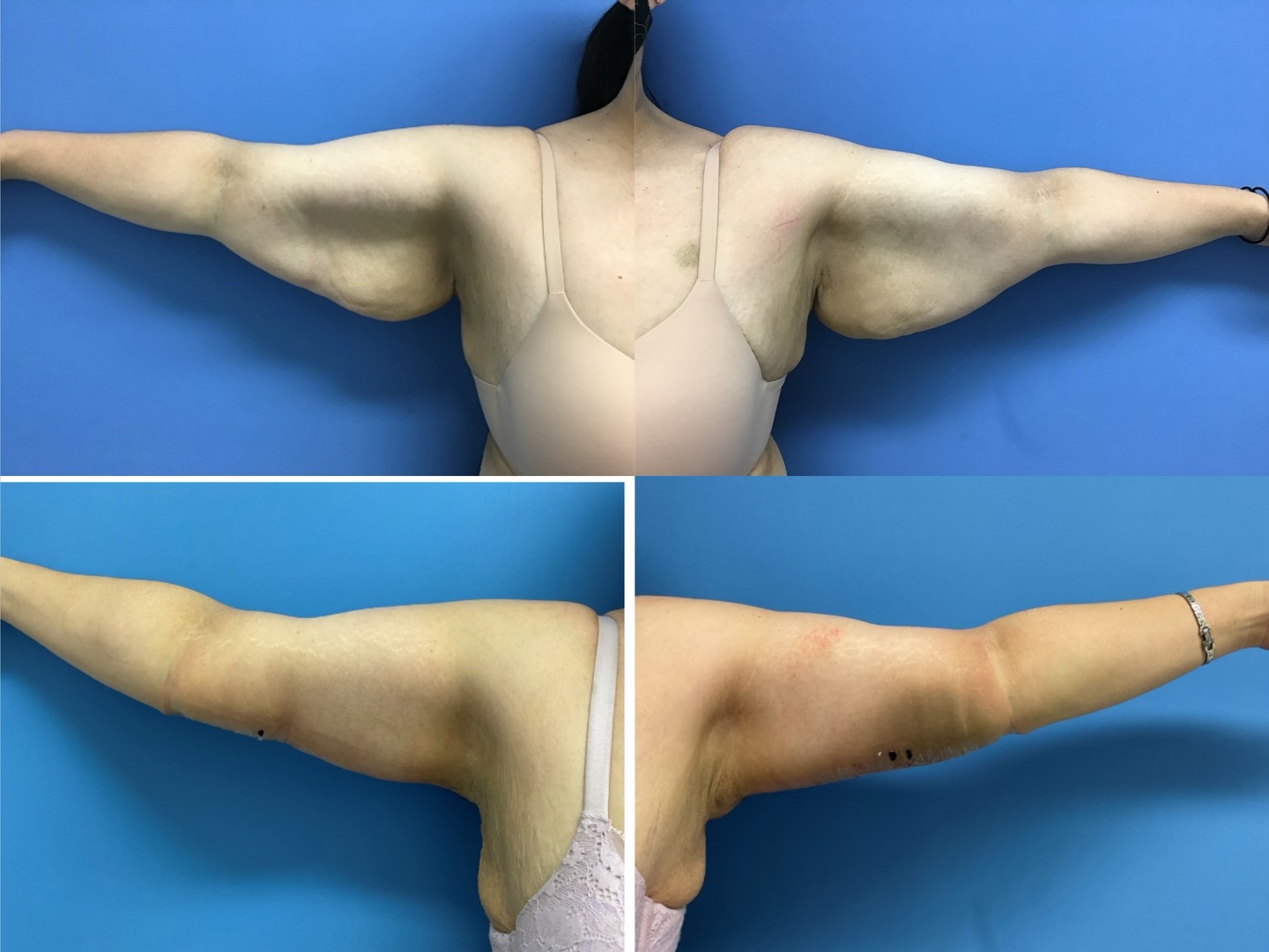 Confidence looks good on everyone 💫
This patient is loving her new arm contour after an expertly performed arm lift by Dr. Chu. A more toned, youthful silhouette can make all the difference.
Ready to feel confident in your skin again?
📞 Book your consultation! 808-524-1551
.
.
.
#HawaiiPlasticSurgery #BoardCertifiedSurgeon #AestheticEnhancement #NaturalLookingResults #Drbenchu