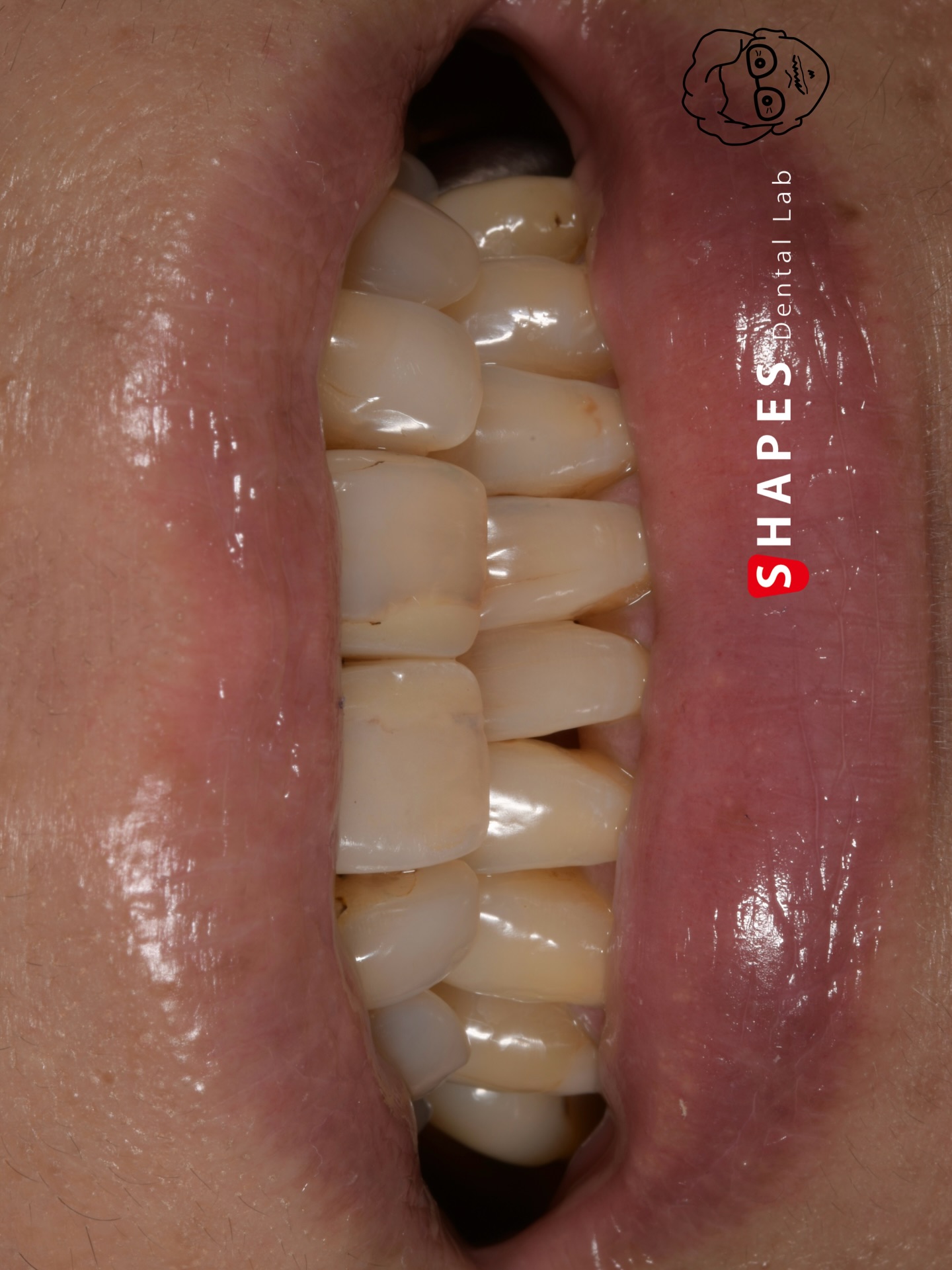 Metal core case🥳
UNC PT coping with e.max Ceram layering
・
・
・
・
・
・
thanks
@ivoclar
@matisse_shadematching
@marat_matisse.ai
@atelierdentaire.international
@olivier.tric
@uncsea
#toothologyst #dentaltechnician #dentallab #dentistry #smile #smilemakeover #dentalphotography#teeth #morphology #layering #zirconiacrown#emaxceram #ivoclarvivadent #prosthodontics #浜松歯科医院#trios#odontologia #stomatolog #zahnarztl#dentalphotography #dentist#стоматология#Dişhekimi#protetikazuba#singlecentral#optishade#smilecloud